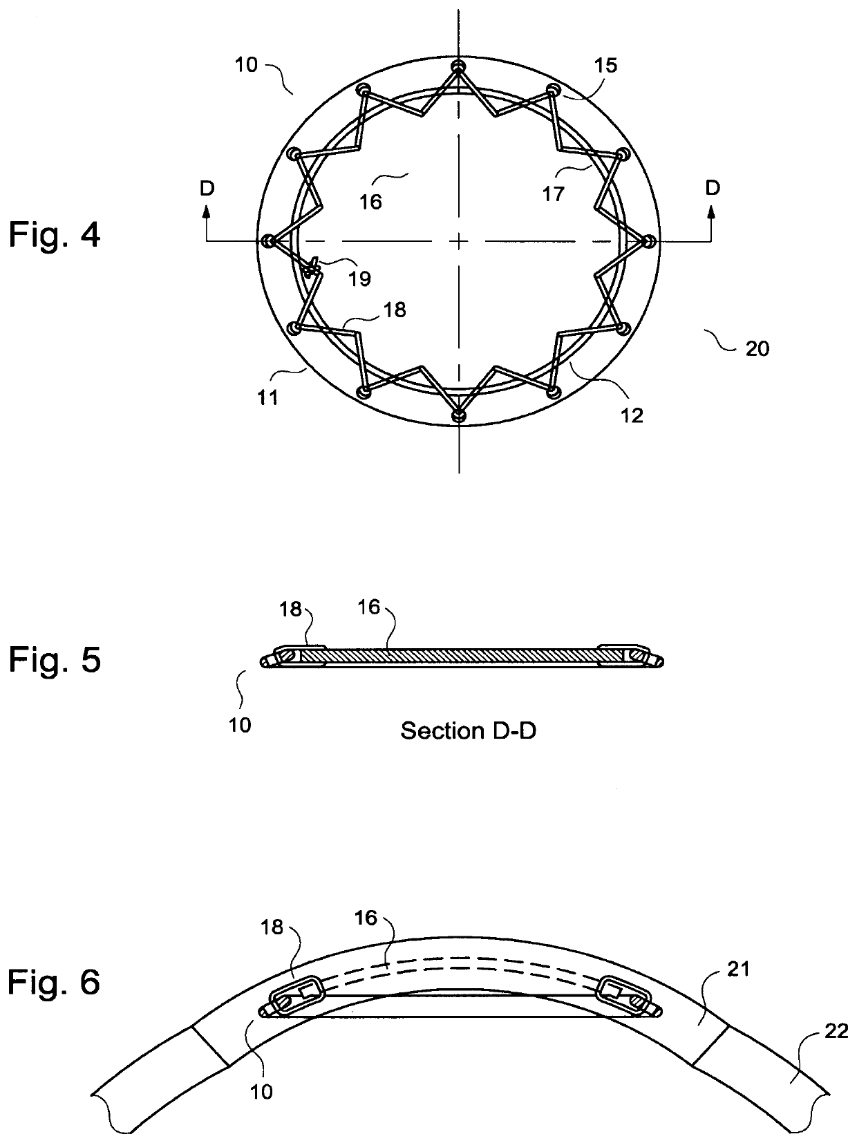 Intracorneal ring supported graft and method for cornea regeneration