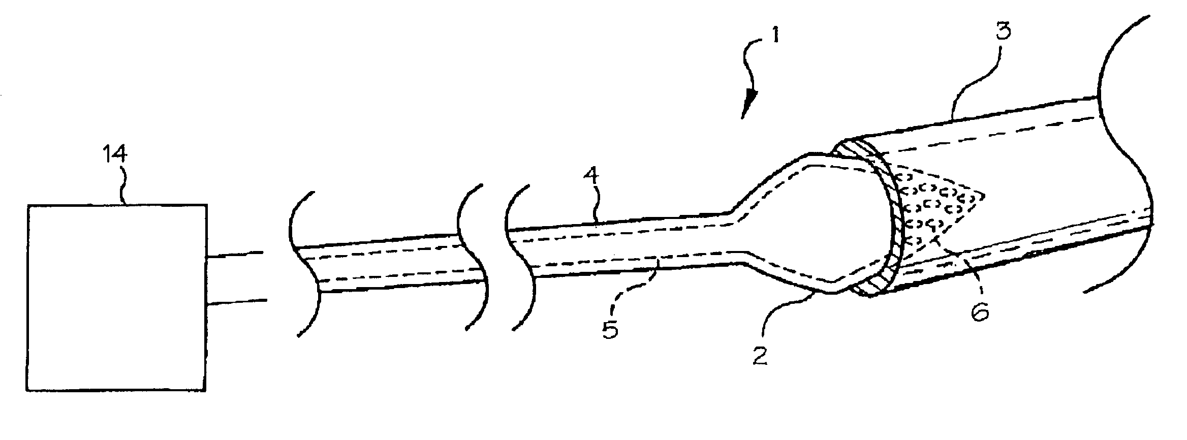 Pulmonary vein arrhythmia diagnostic device and method for use