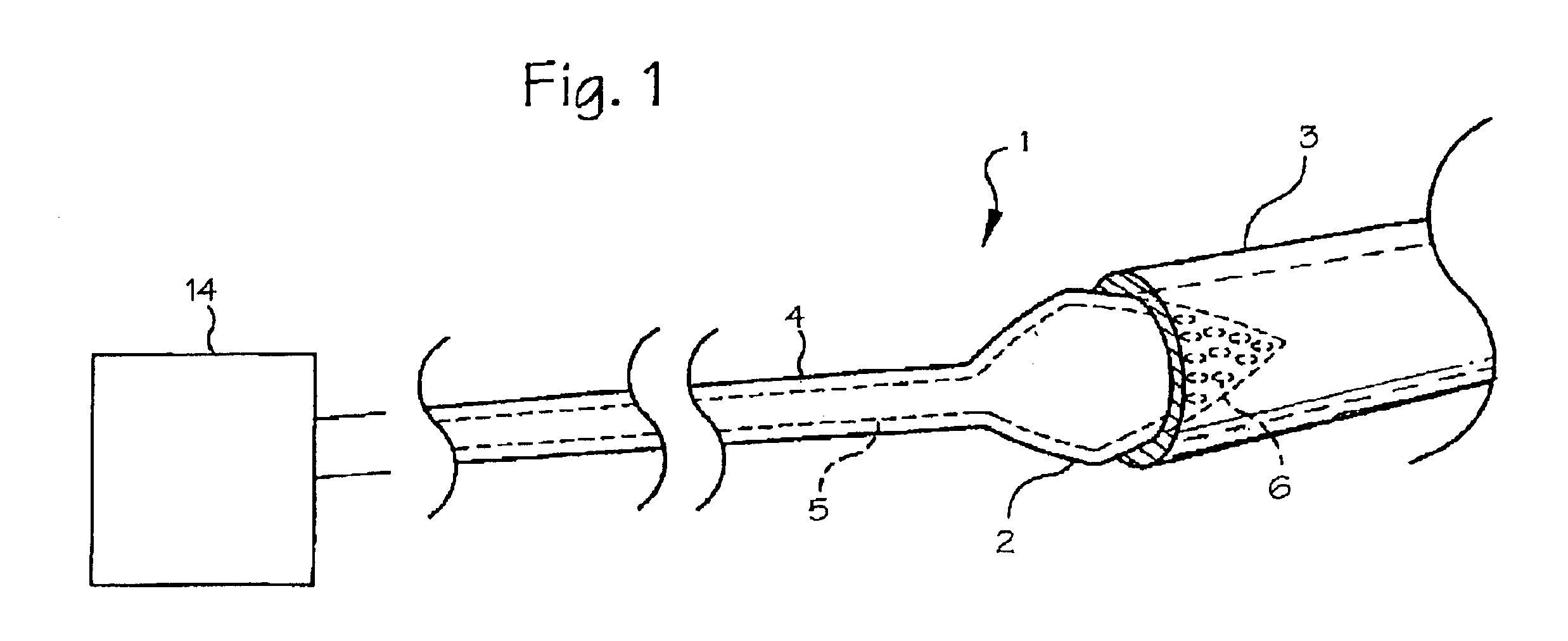 Pulmonary vein arrhythmia diagnostic device and method for use