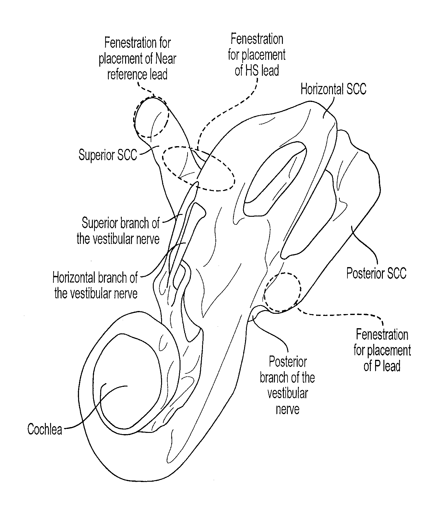 Implantable vestibular prosthesis