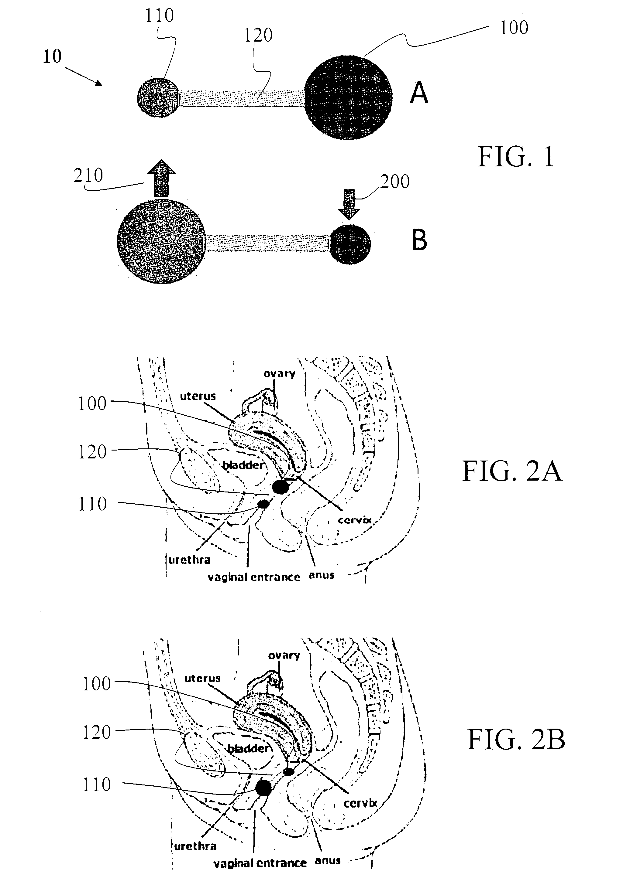 Medical device for treatment of urinary incontinence in females