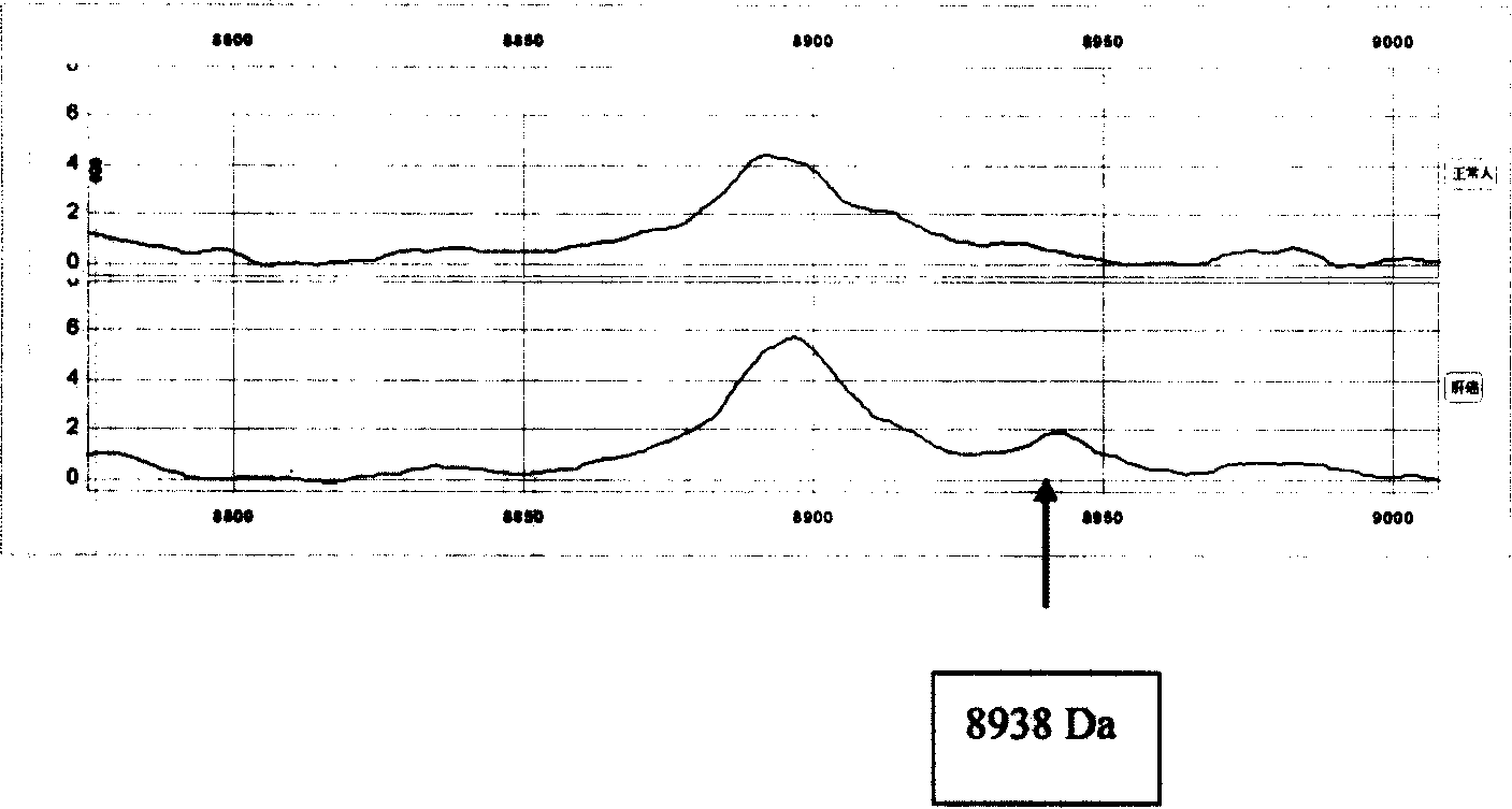 Reagent kit and method for judging normal person and liver cancer using magnetic bead supported matrix