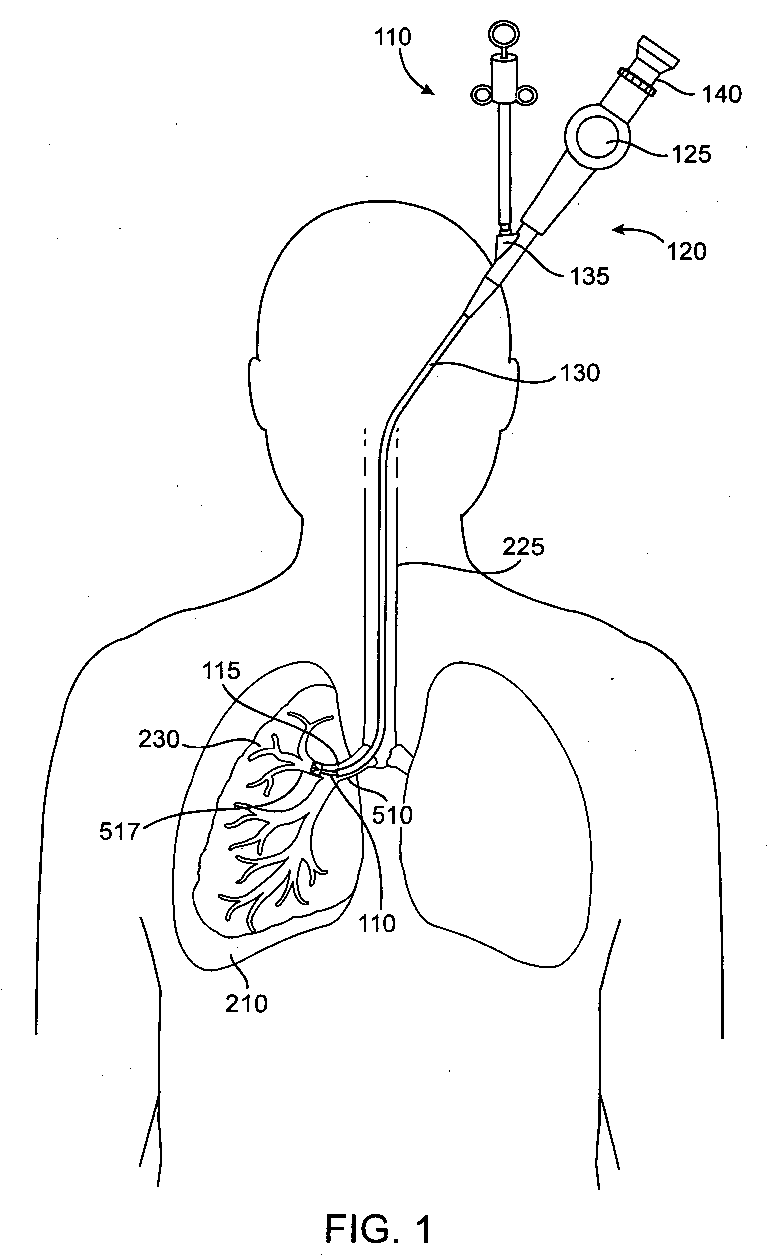 Delivery methods and devices for implantable bronchial isolation devices