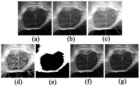 Construction Method of Similarity Matrix in ncut Segmentation of Ultrasonic Image