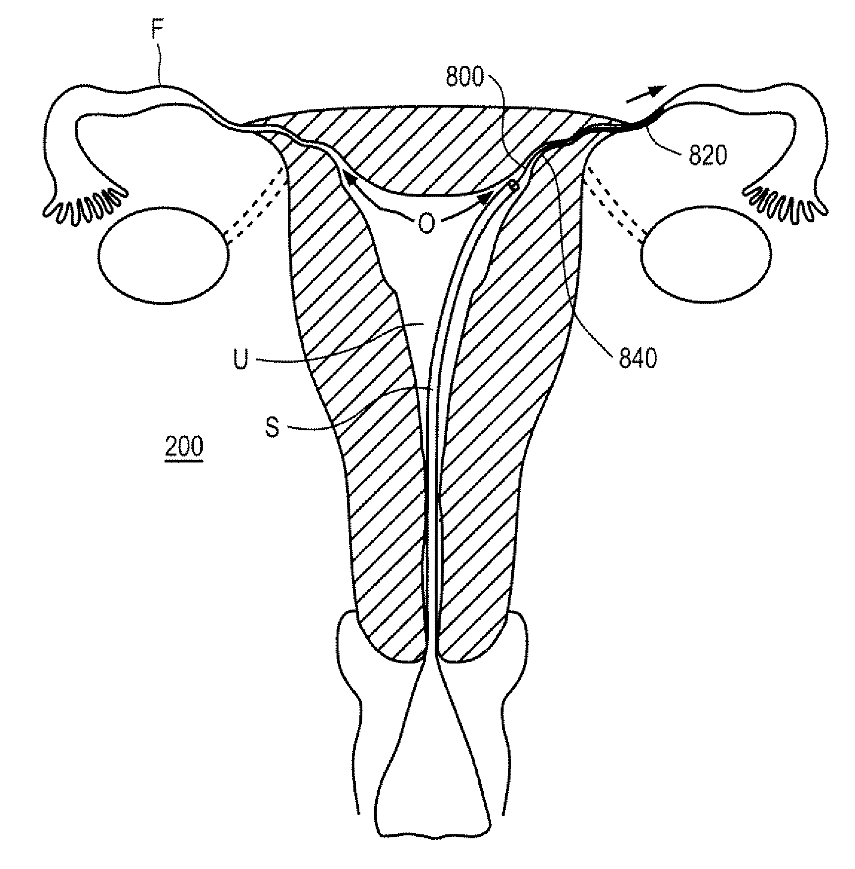 Minimally invasive delivery devices and methods