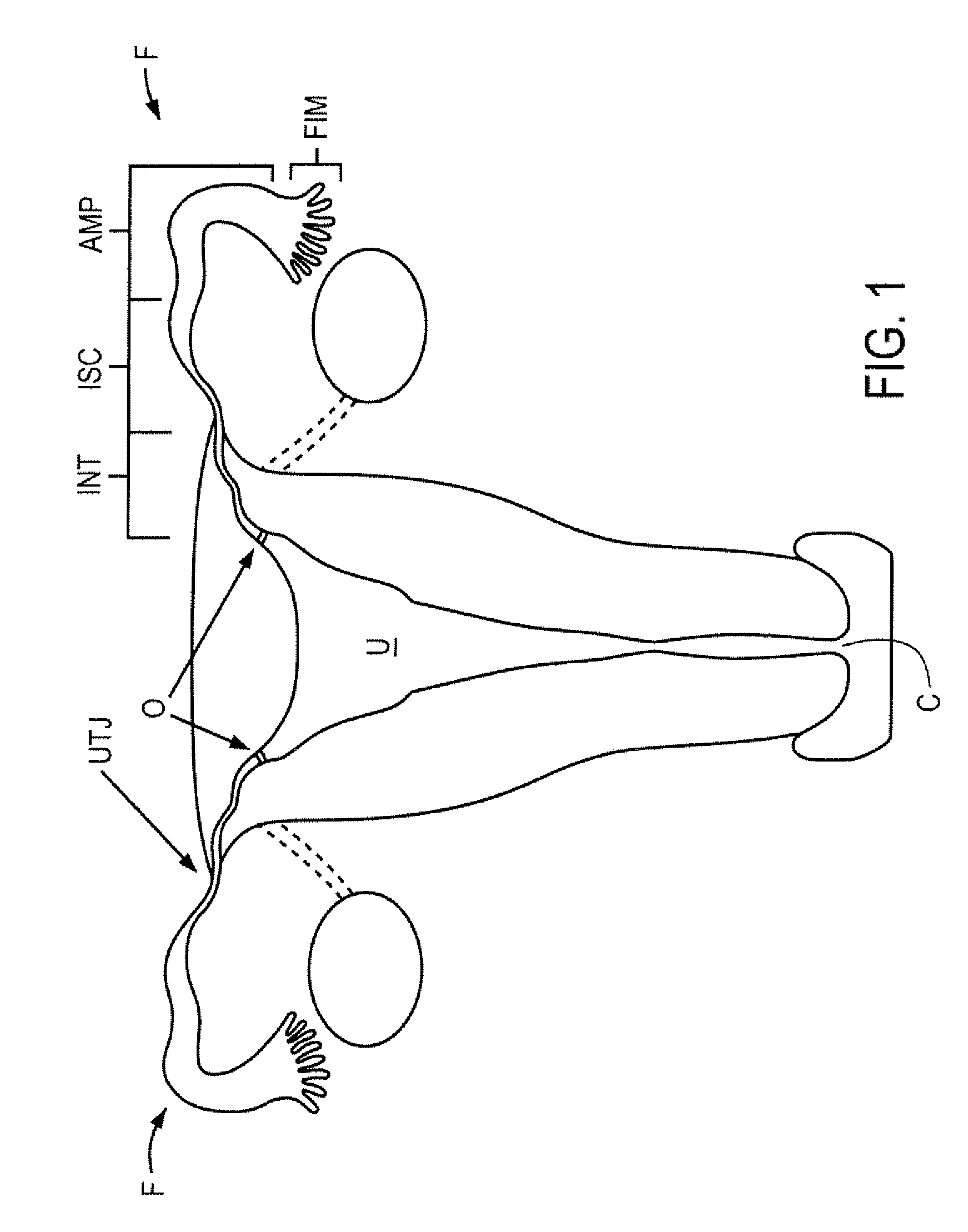Minimally invasive delivery devices and methods