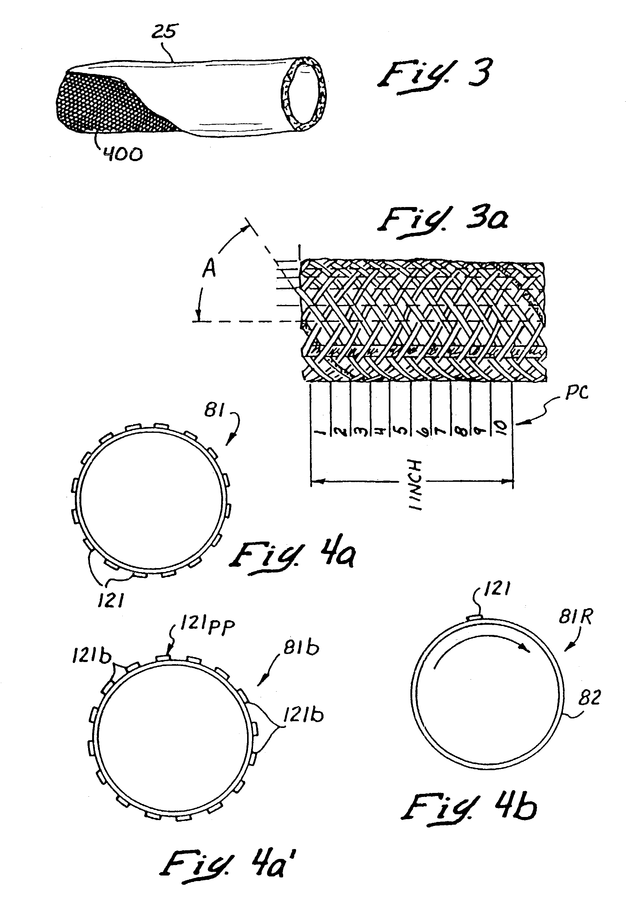 Methods for bypassing total or near-total obstructions in arteries or other anatomical conduits
