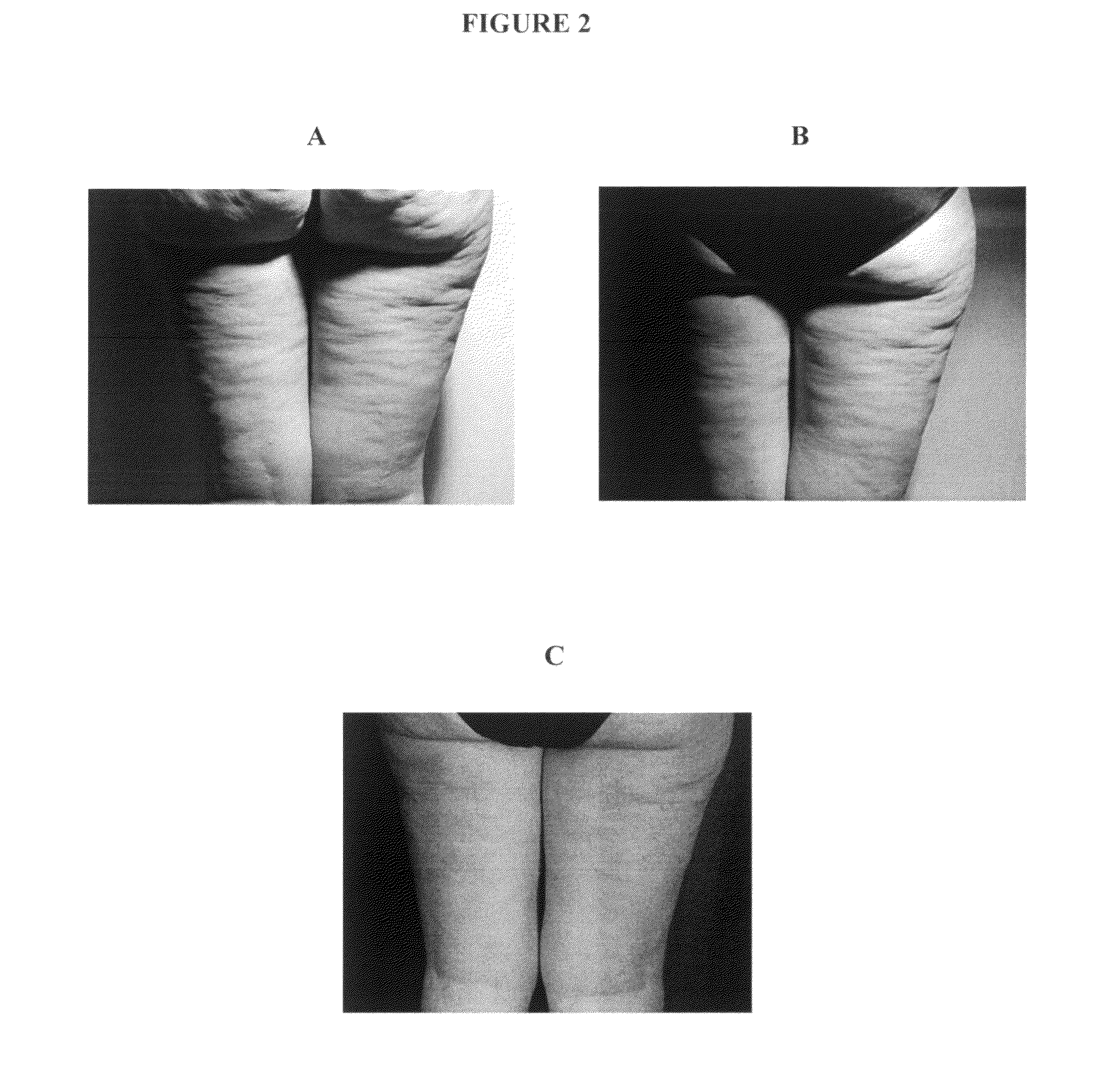 PDT treatment method for cellulites and cosmetic use