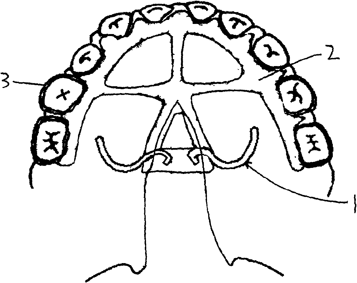 Traction device used in oral cavity for treating cleft palate made of nickel-titanium memory alloy