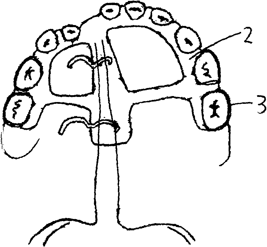 Traction device used in oral cavity for treating cleft palate made of nickel-titanium memory alloy