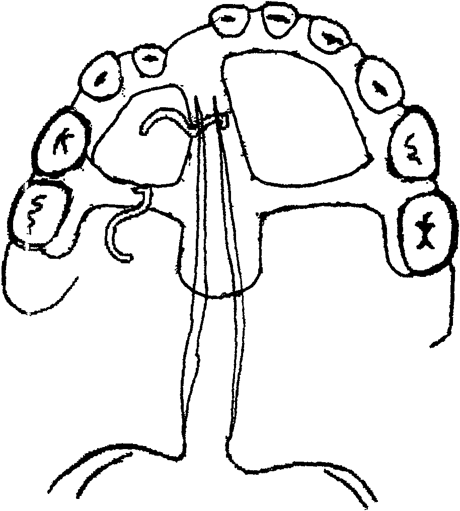 Traction device used in oral cavity for treating cleft palate made of nickel-titanium memory alloy