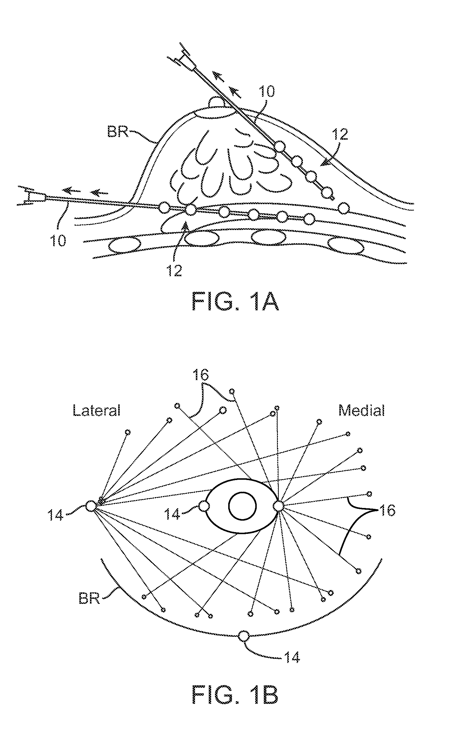 Devices and methods for tissue transfer