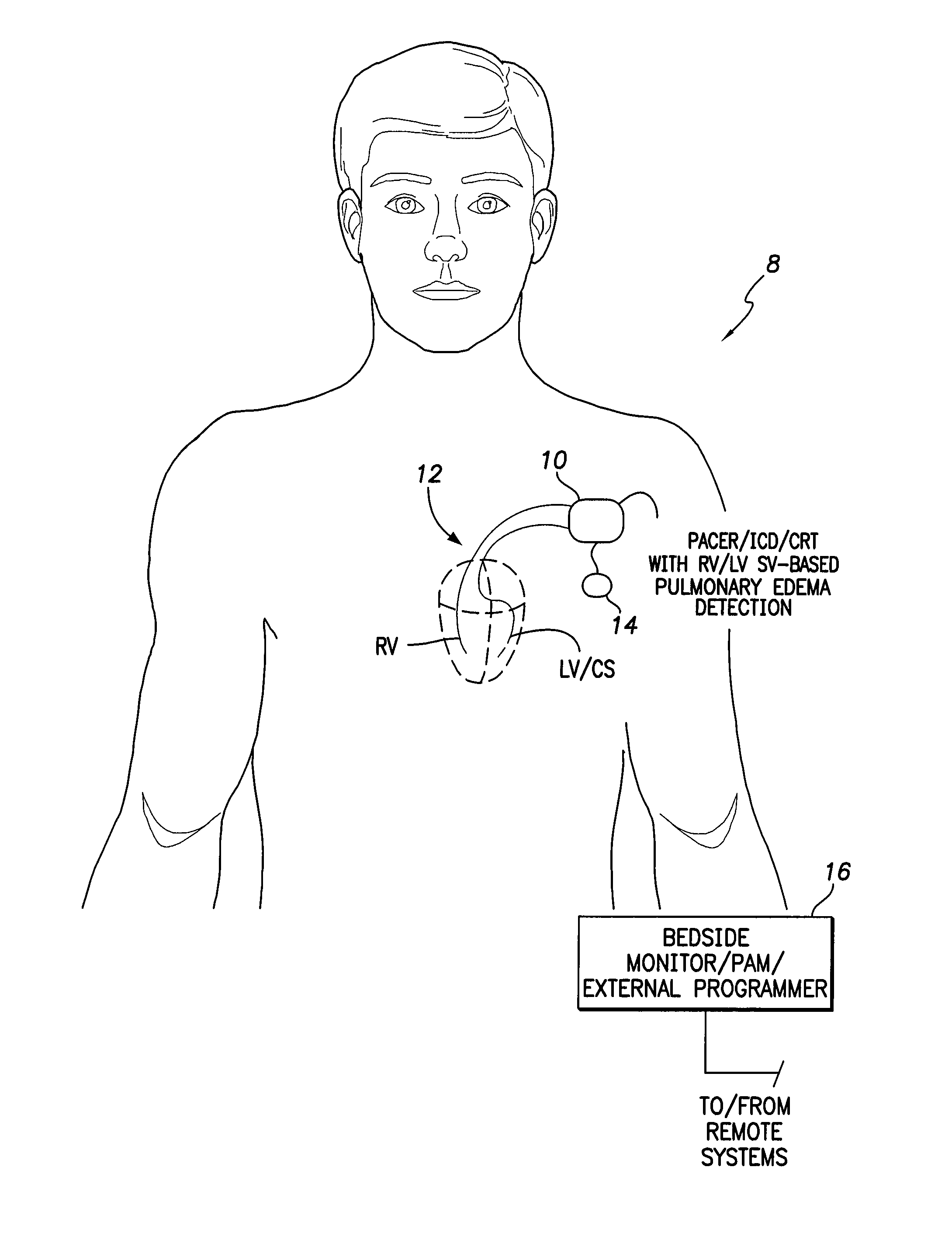 System and method for detecting pulmonary congestion based on stroke volume using an implantable medical device