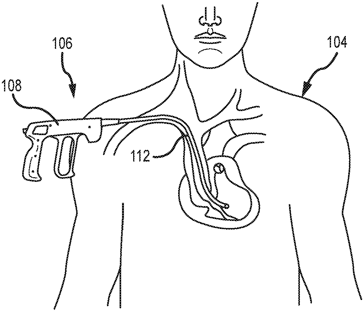 Medical device for removing an implanted object using laser cut hypotubes