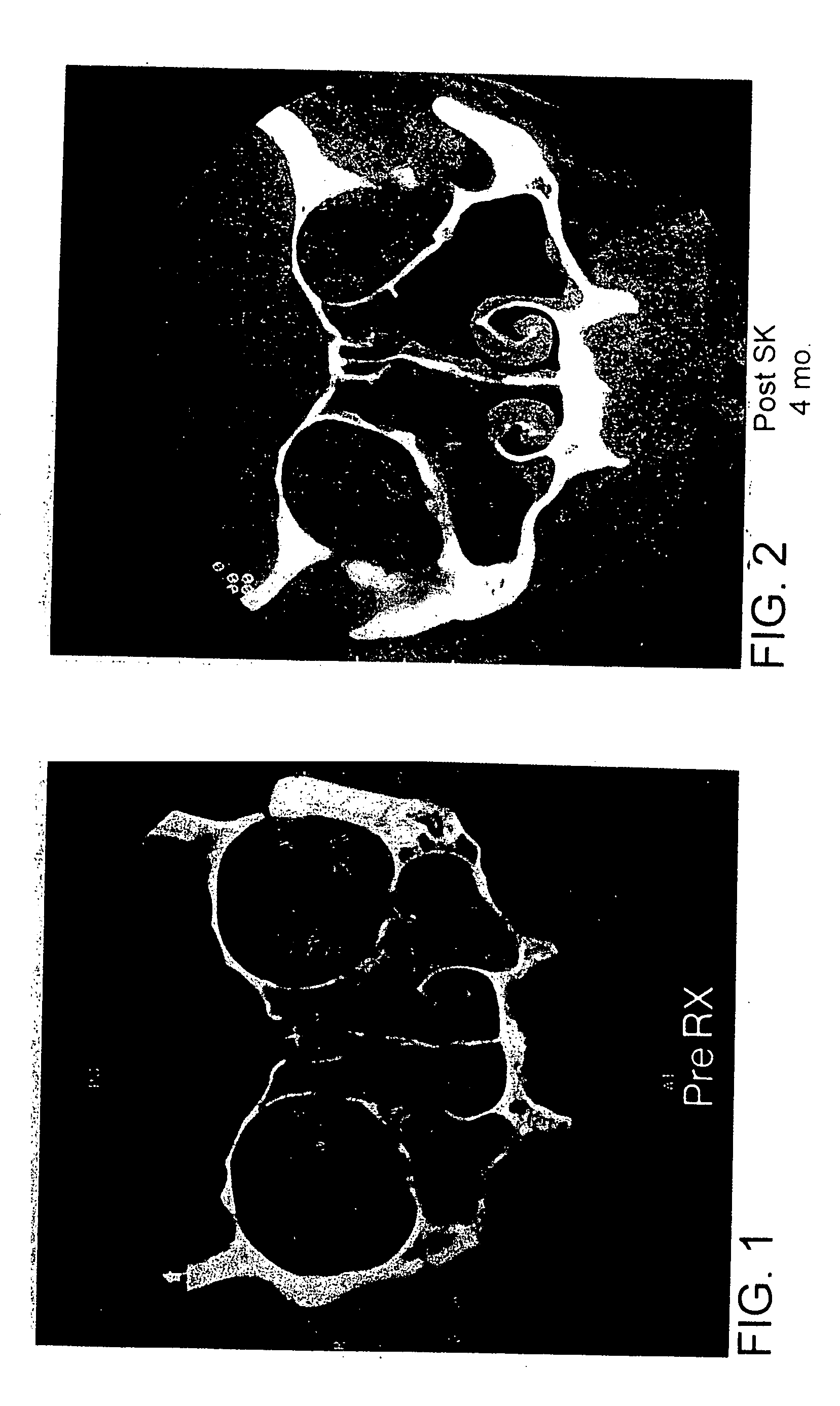 Methods and materials for treating and preventing inflammation of mucosal tissue