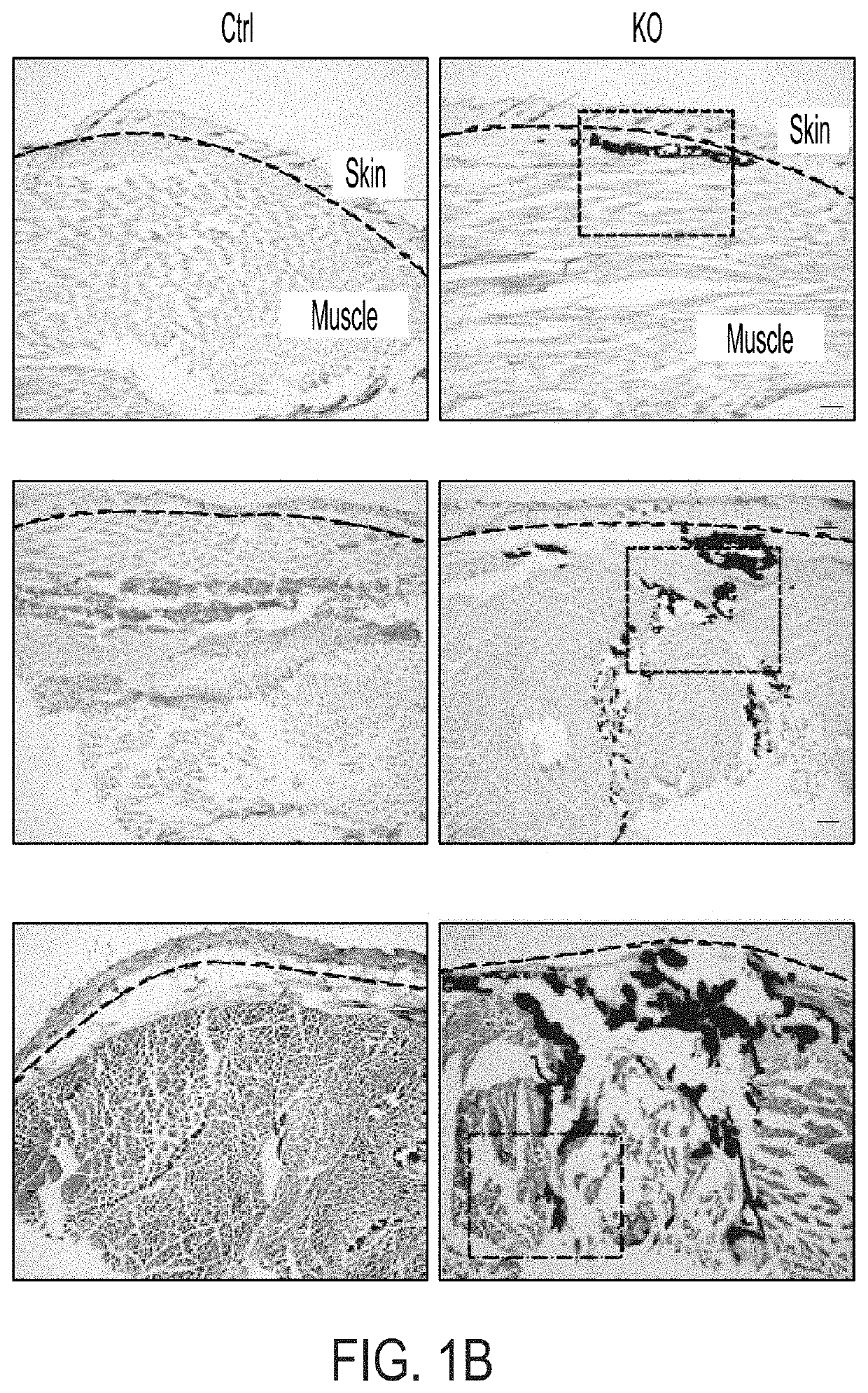 Methods and compositions for treating heterotopic ossification