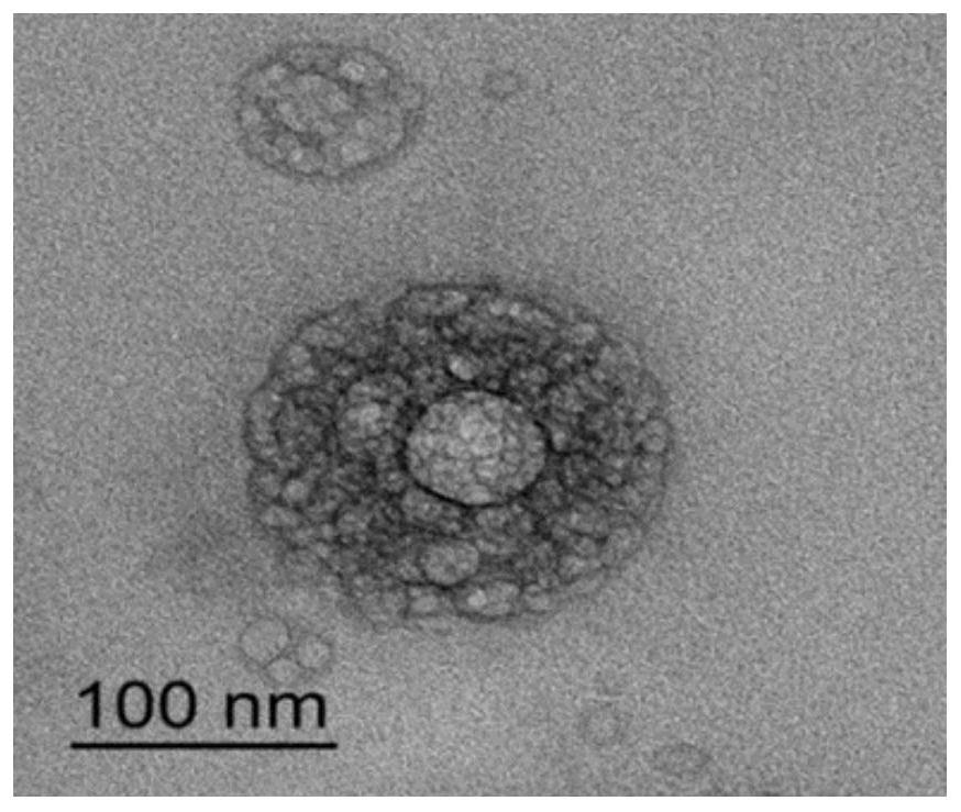 Liposome-nanoparticle hybrids for treating chronic glomerulonephritis