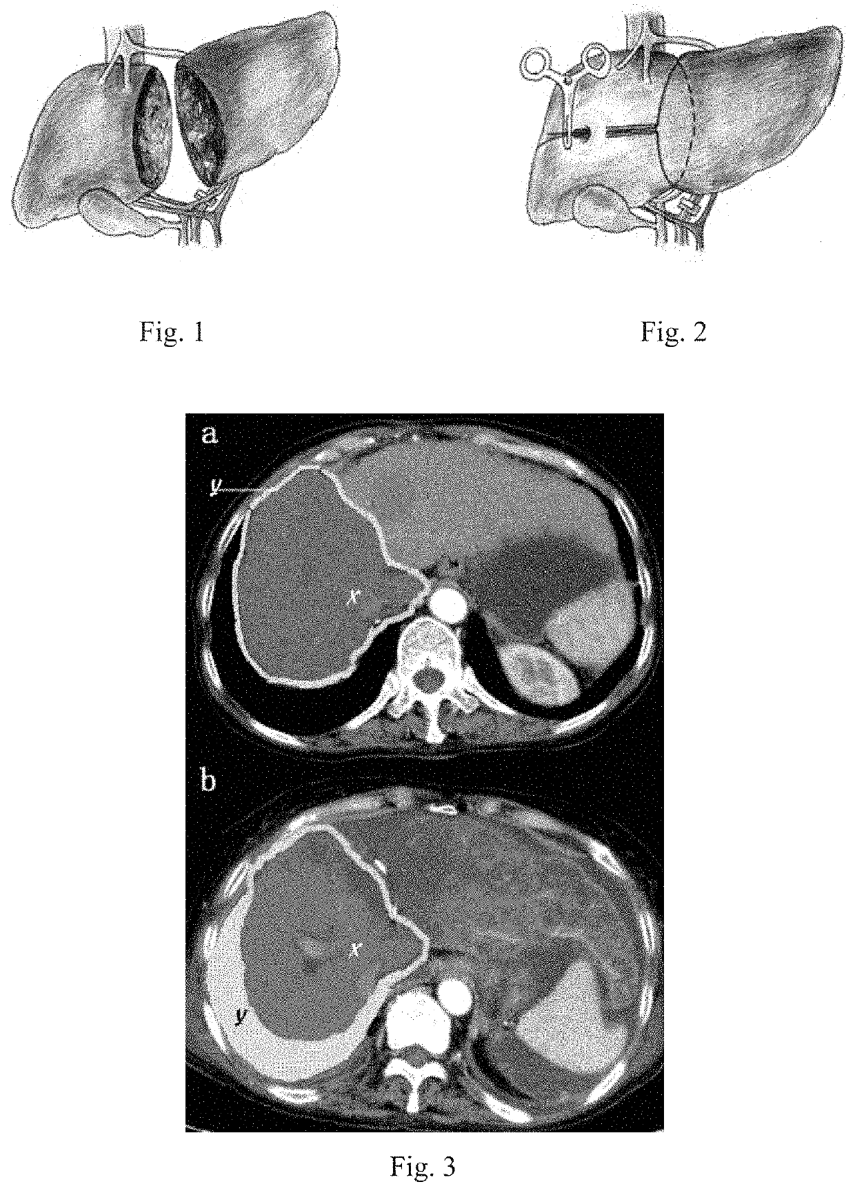 Completely laparoscopic staged hepatectomy using round-the-liver ligation and its instrument
