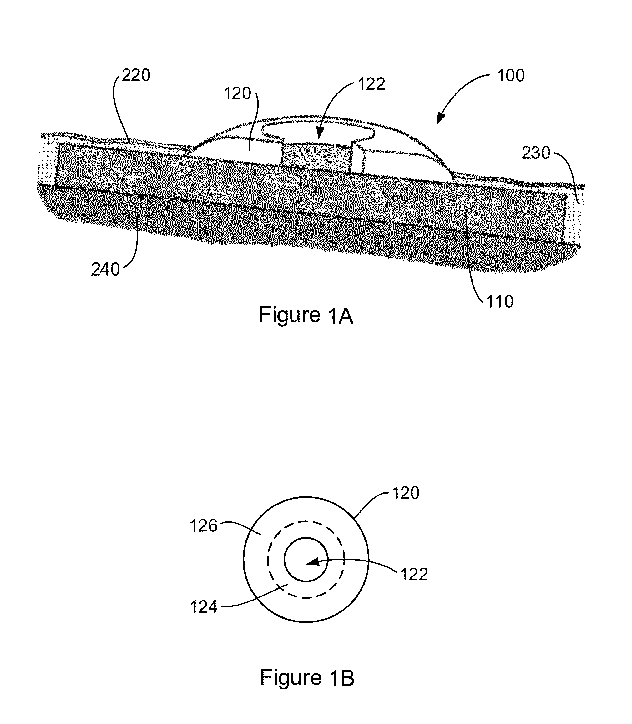 Implantable interface device