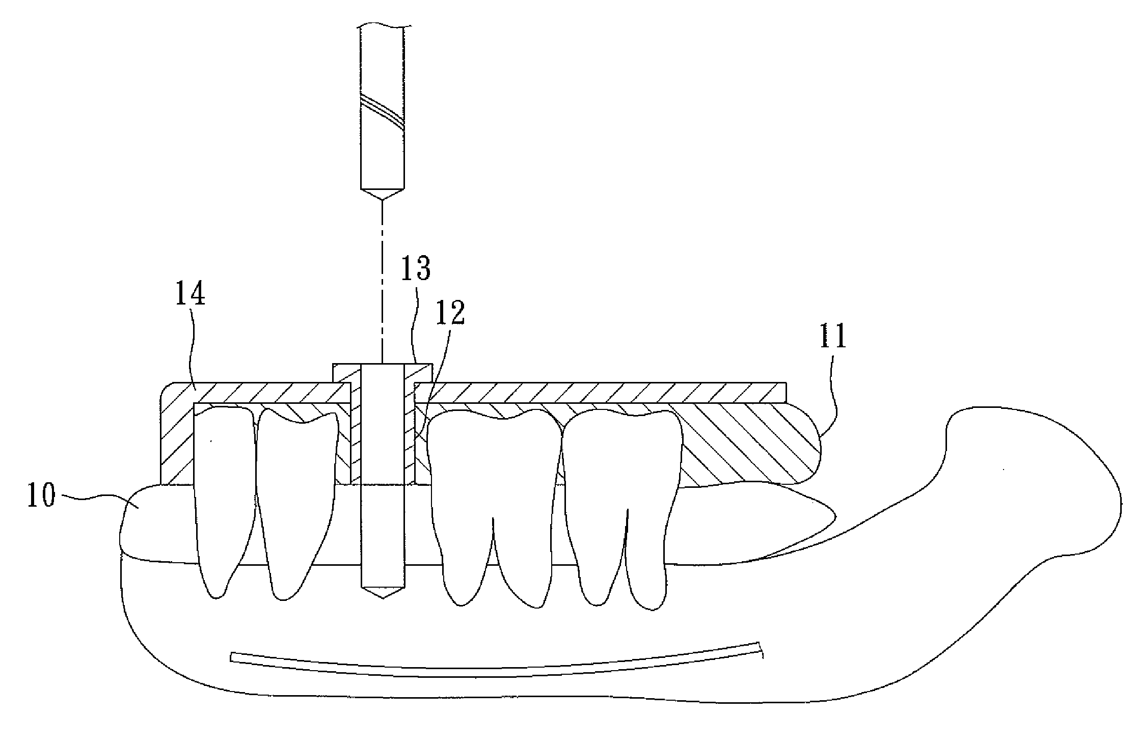 Method of making a surgical template used for a computer-guided dental implant surgery