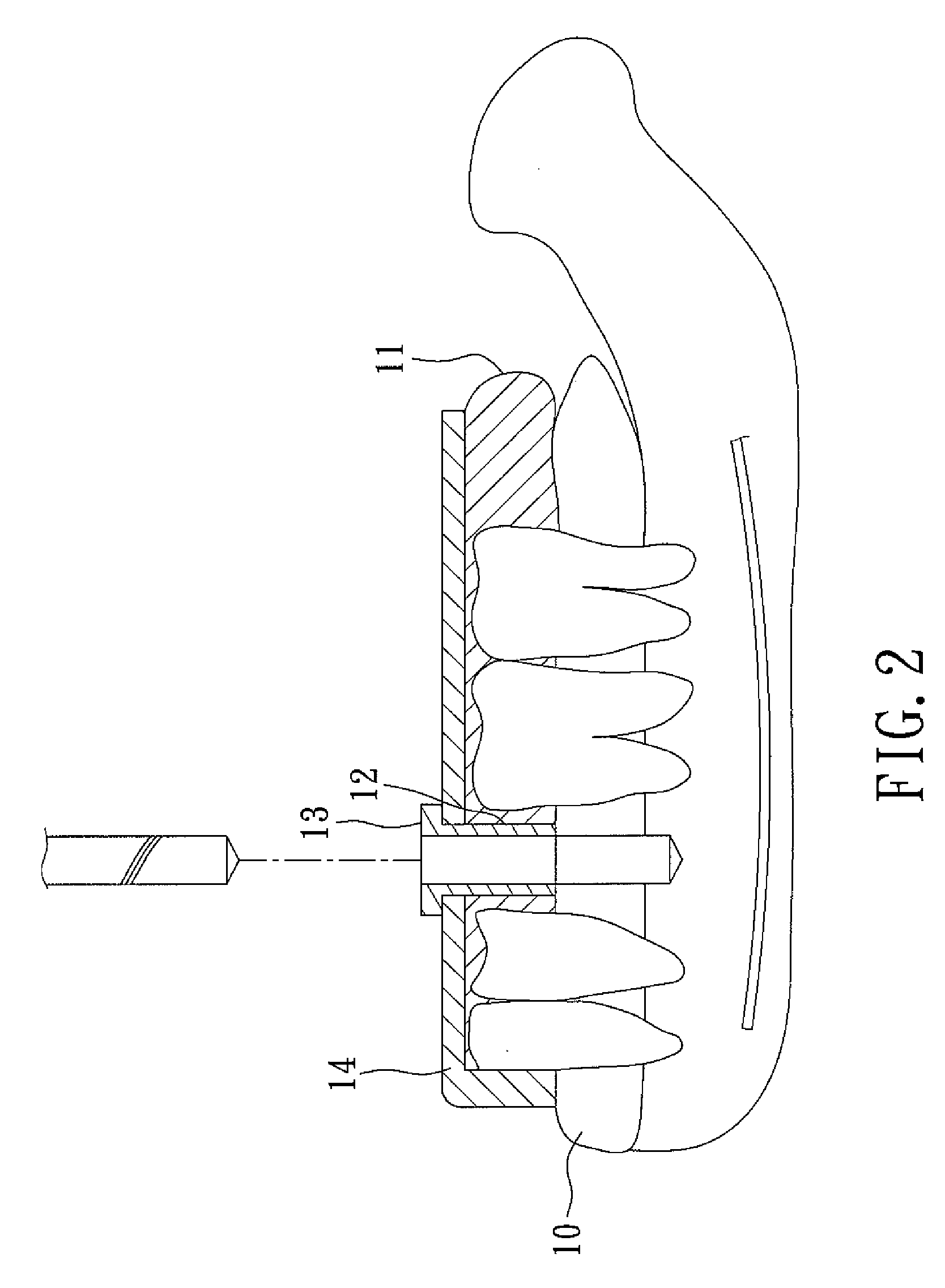 Method of making a surgical template used for a computer-guided dental implant surgery