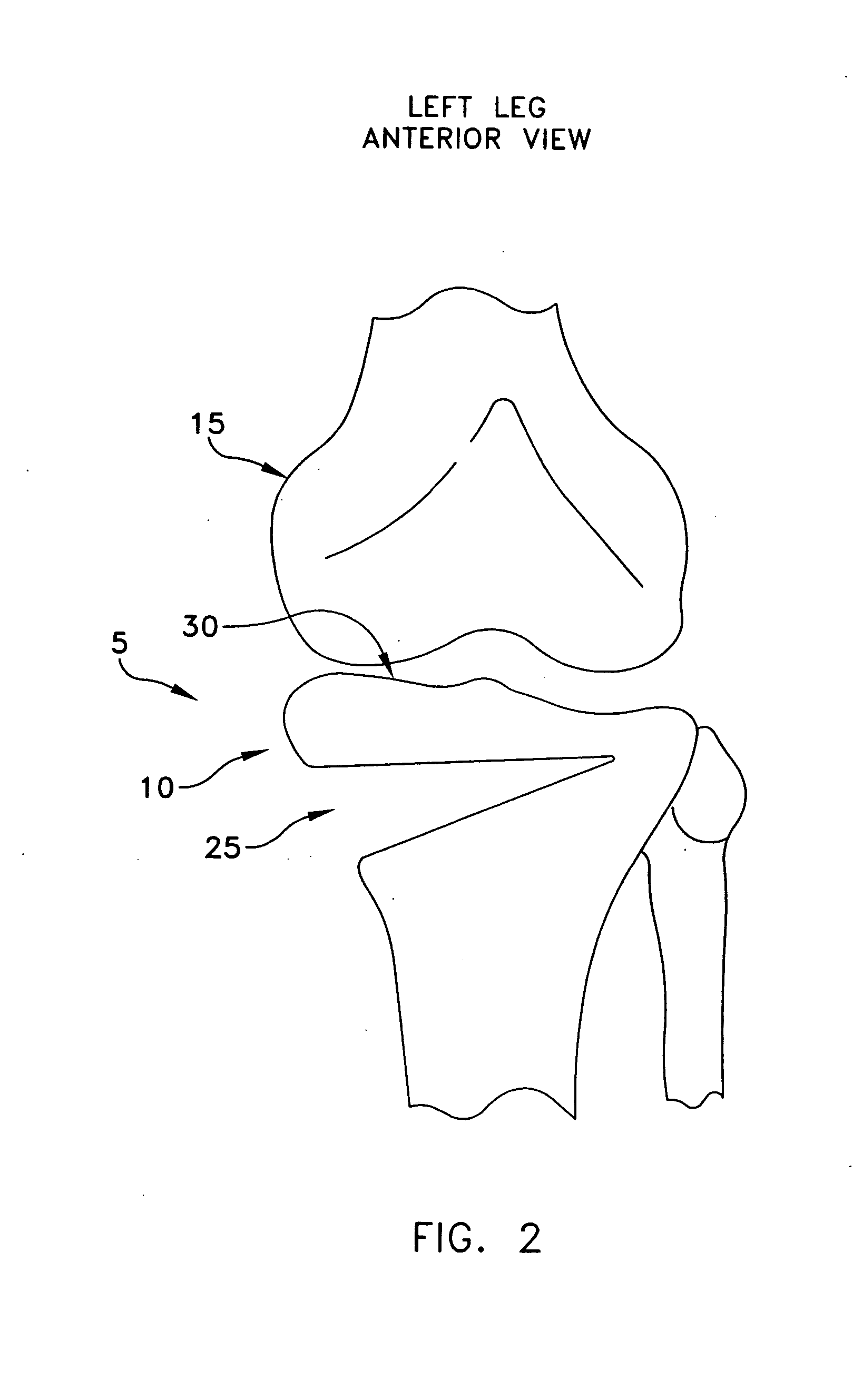 Method and appartus for performing an open, wedge, high tibial osteotomy