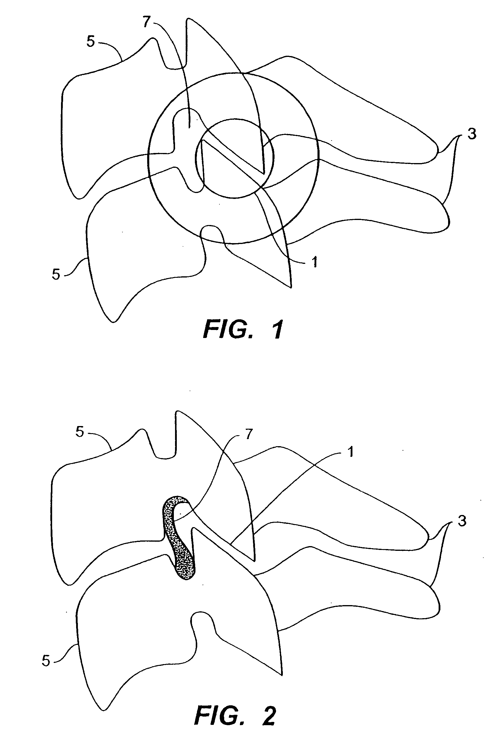 Inter-cervical facet joint implant with locking screw system