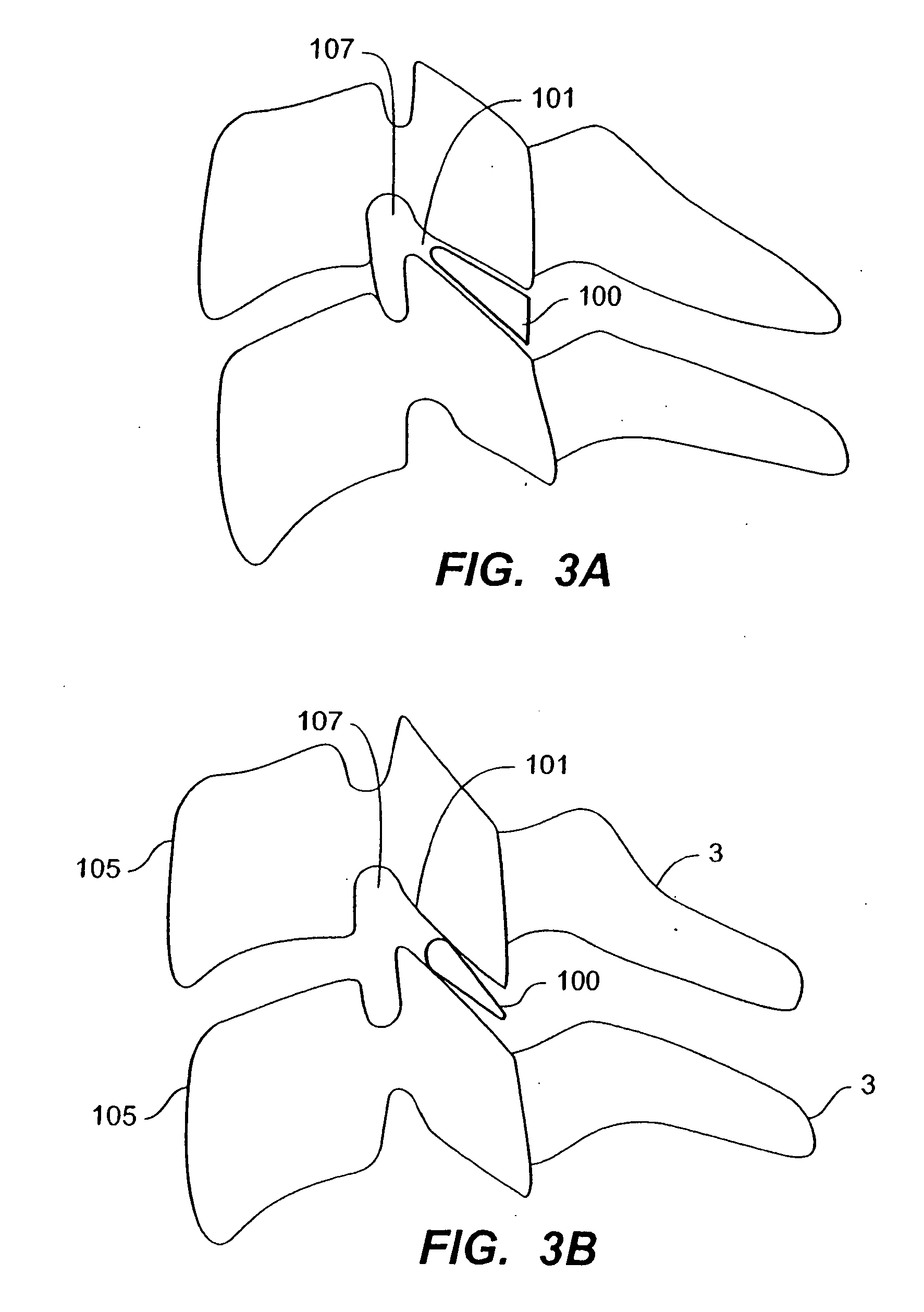 Inter-cervical facet joint implant with locking screw system