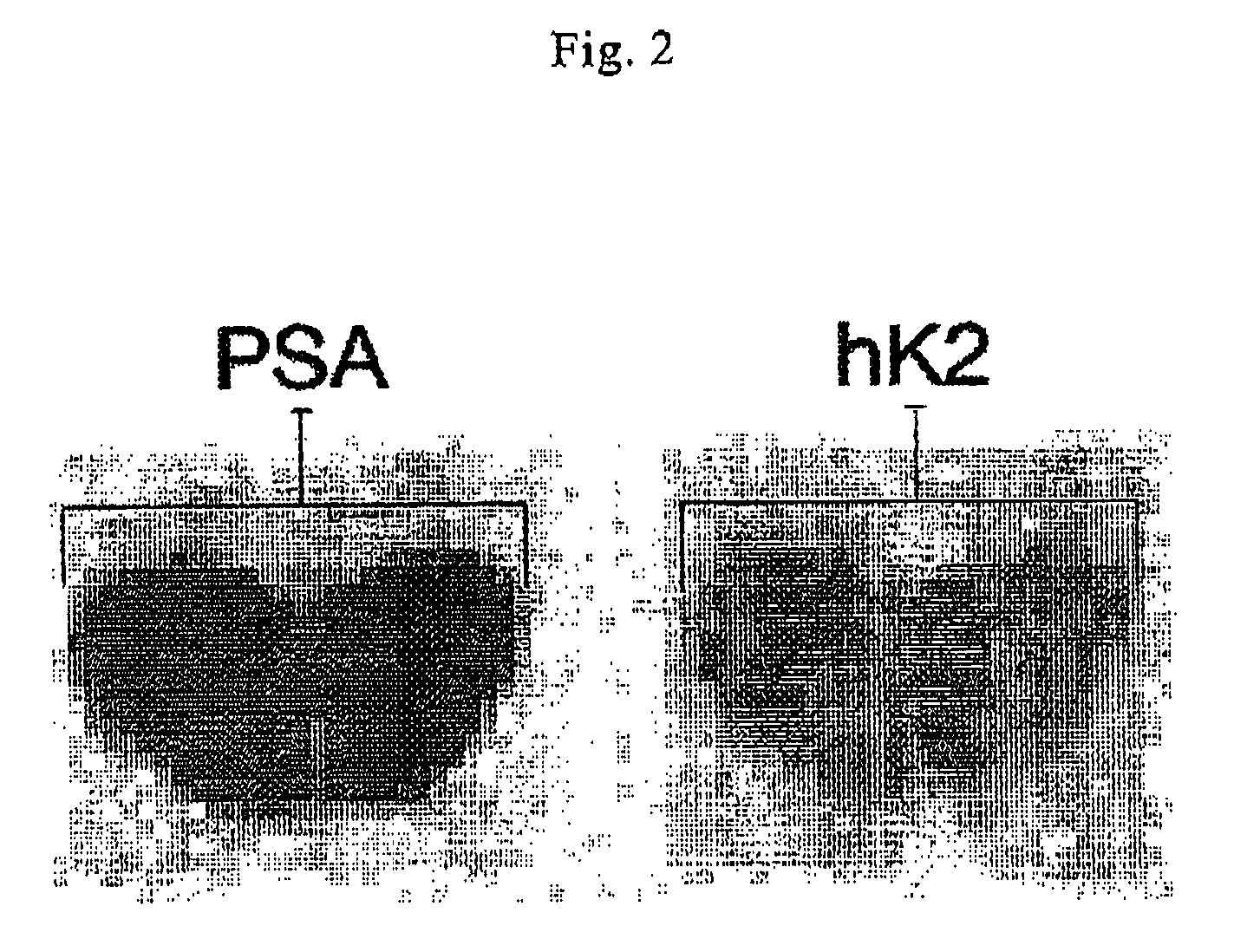 Diagnosis of prostate cancer