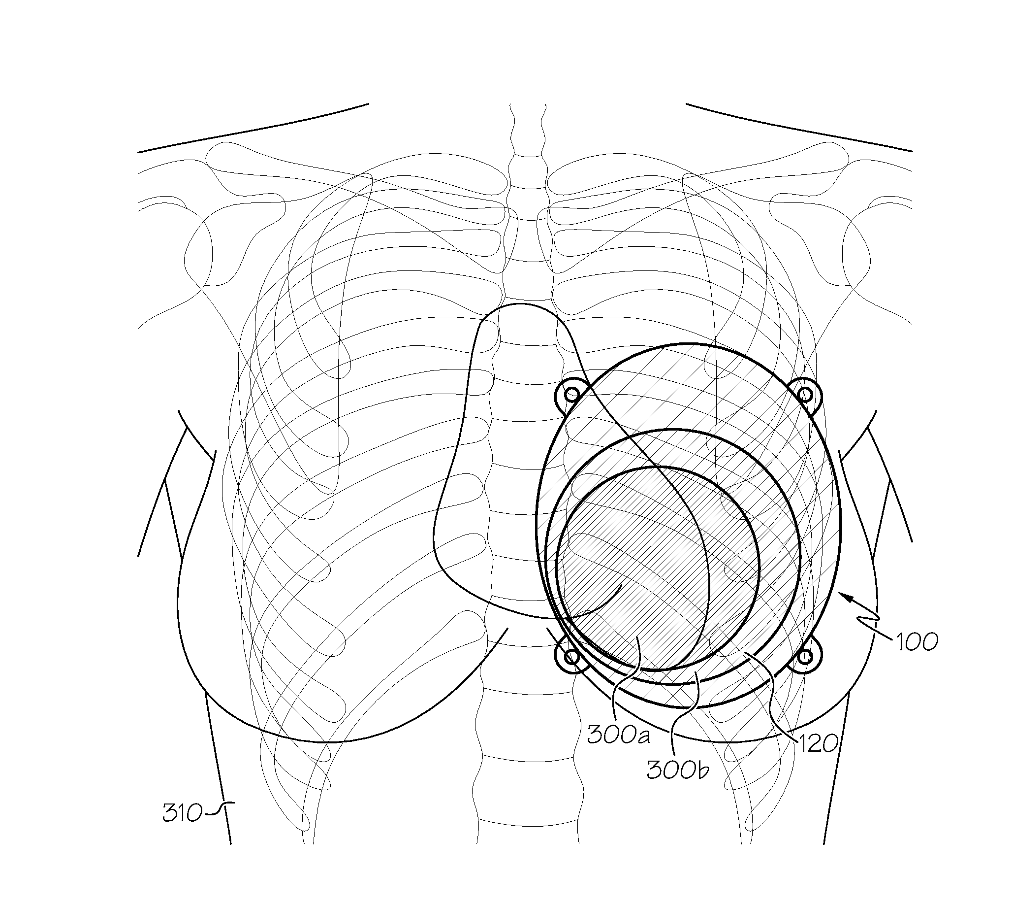 Radiation shielding implants and methods of use