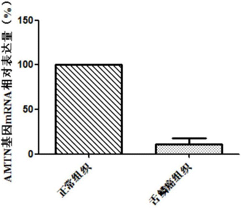 Molecular markerfor diagnosis and treatment of tongue squamous carcinoma