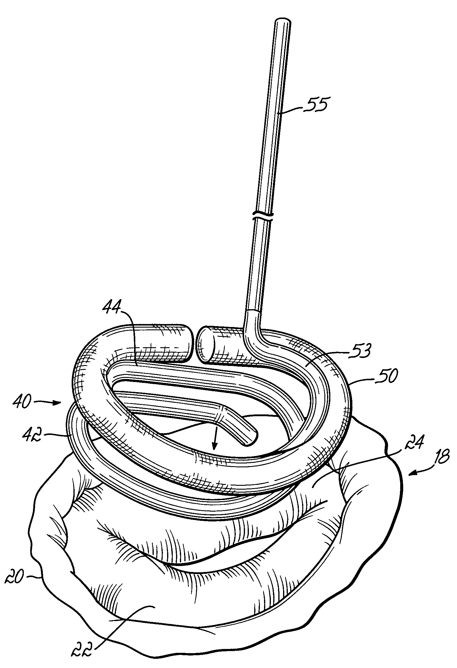 Annuloplasty instrument