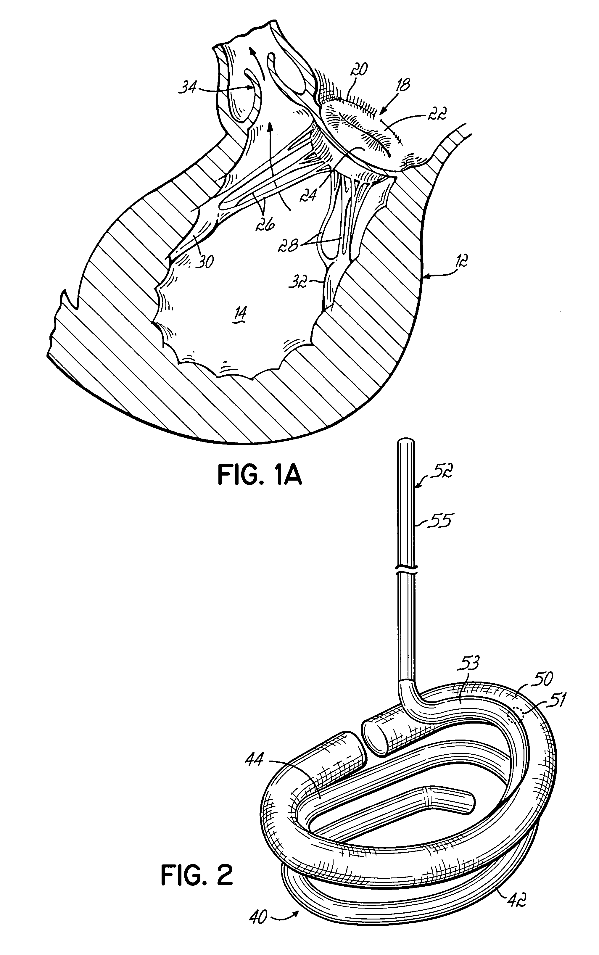 Annuloplasty instrument