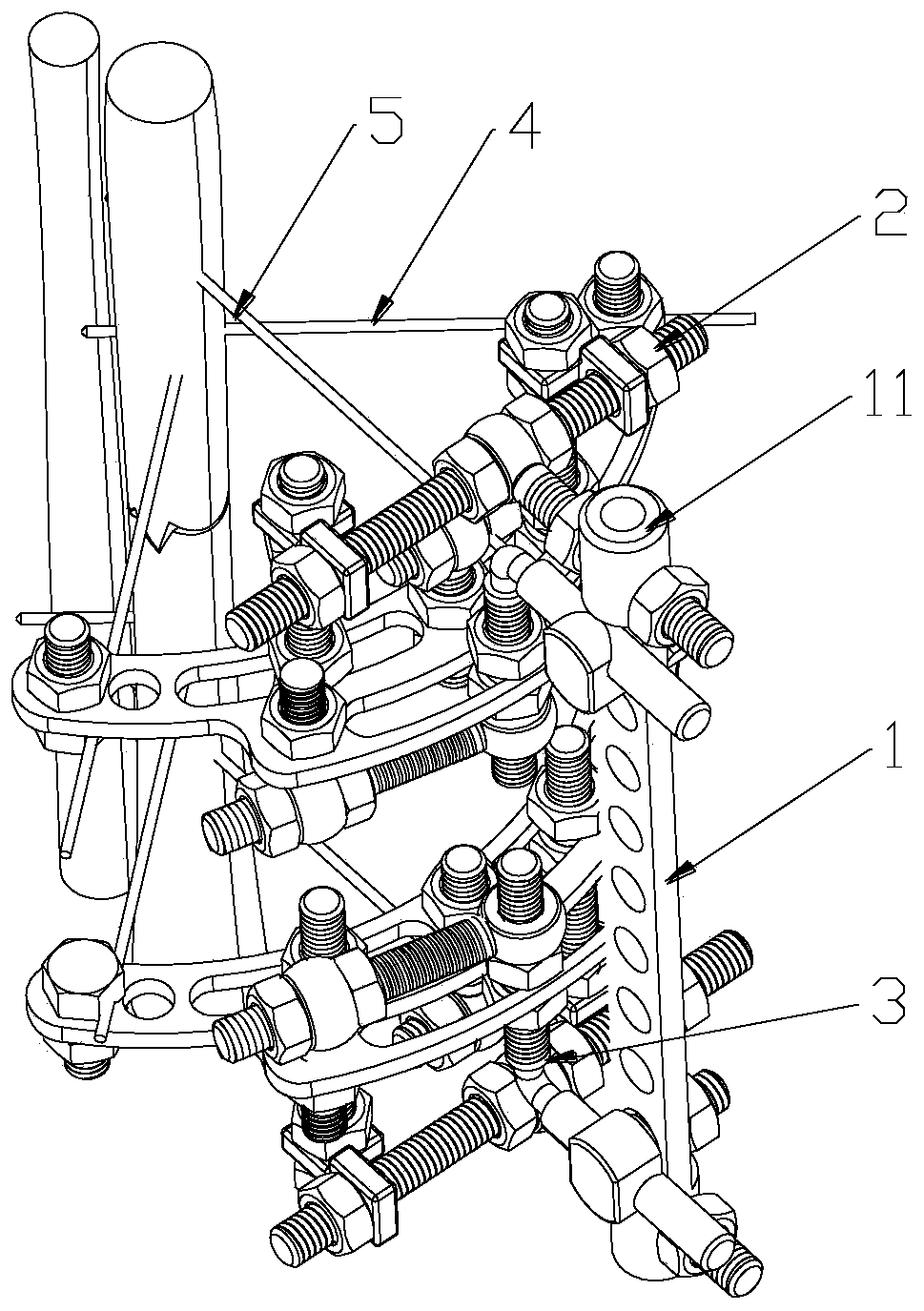 A bone pin fixation device for treating long bone fractures