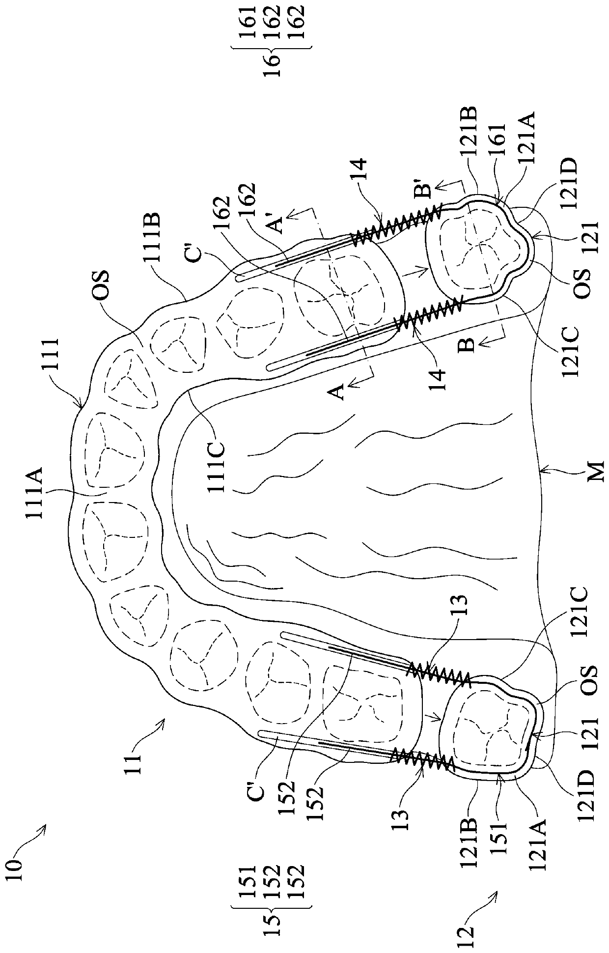 Removable orthodontic device