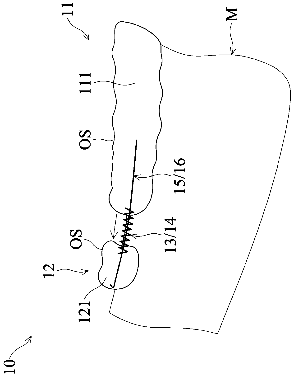 Removable orthodontic device