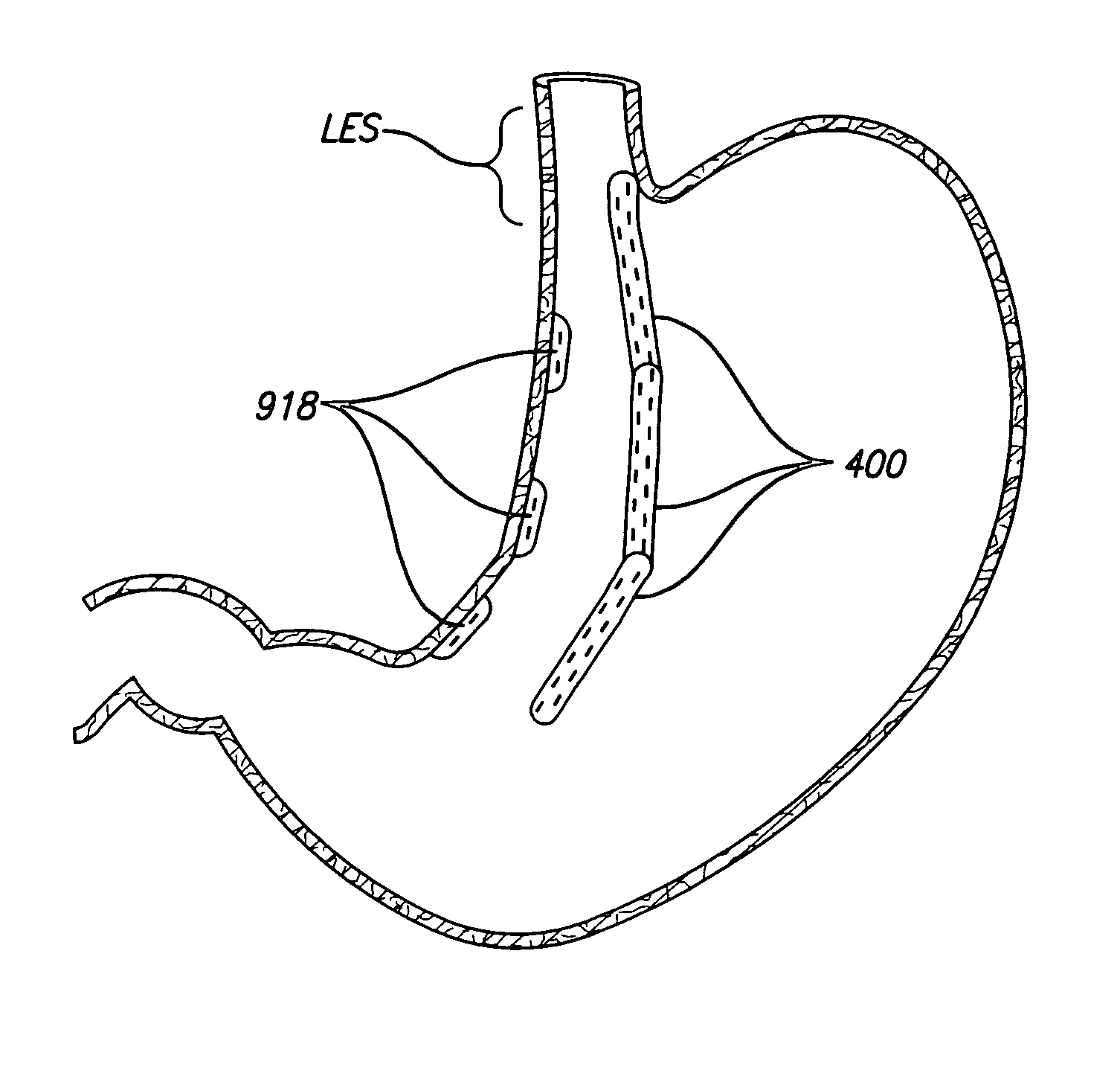 Devices and methods for placement of partitions within a hollow body organ