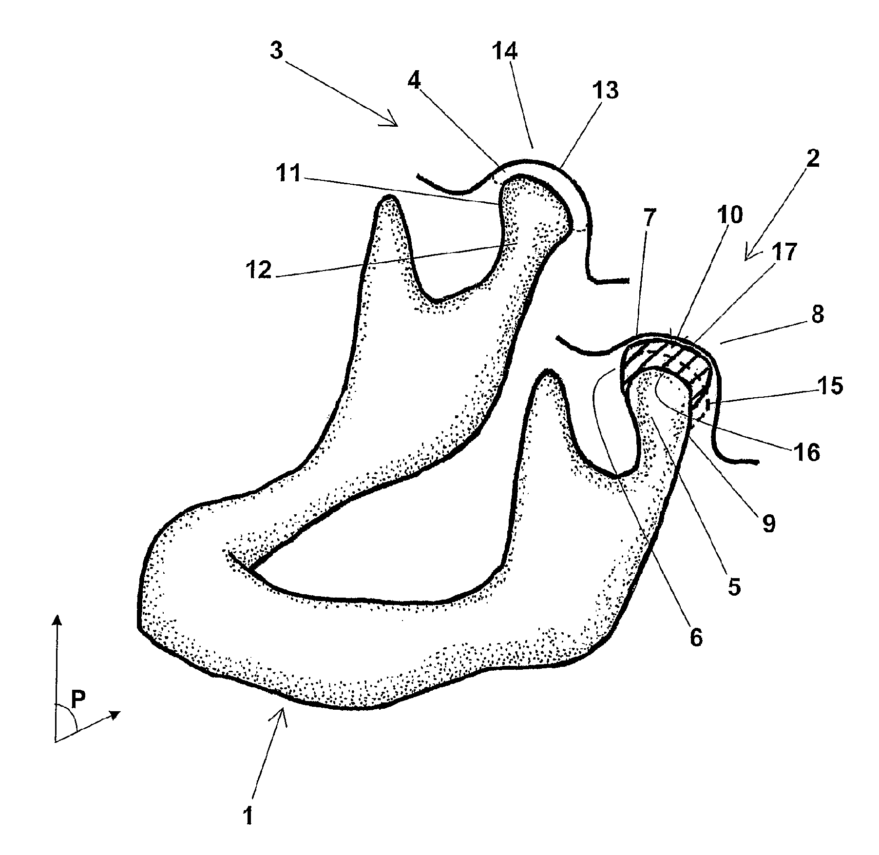 Temporomandibular prosthetic implant, and corresponding production method