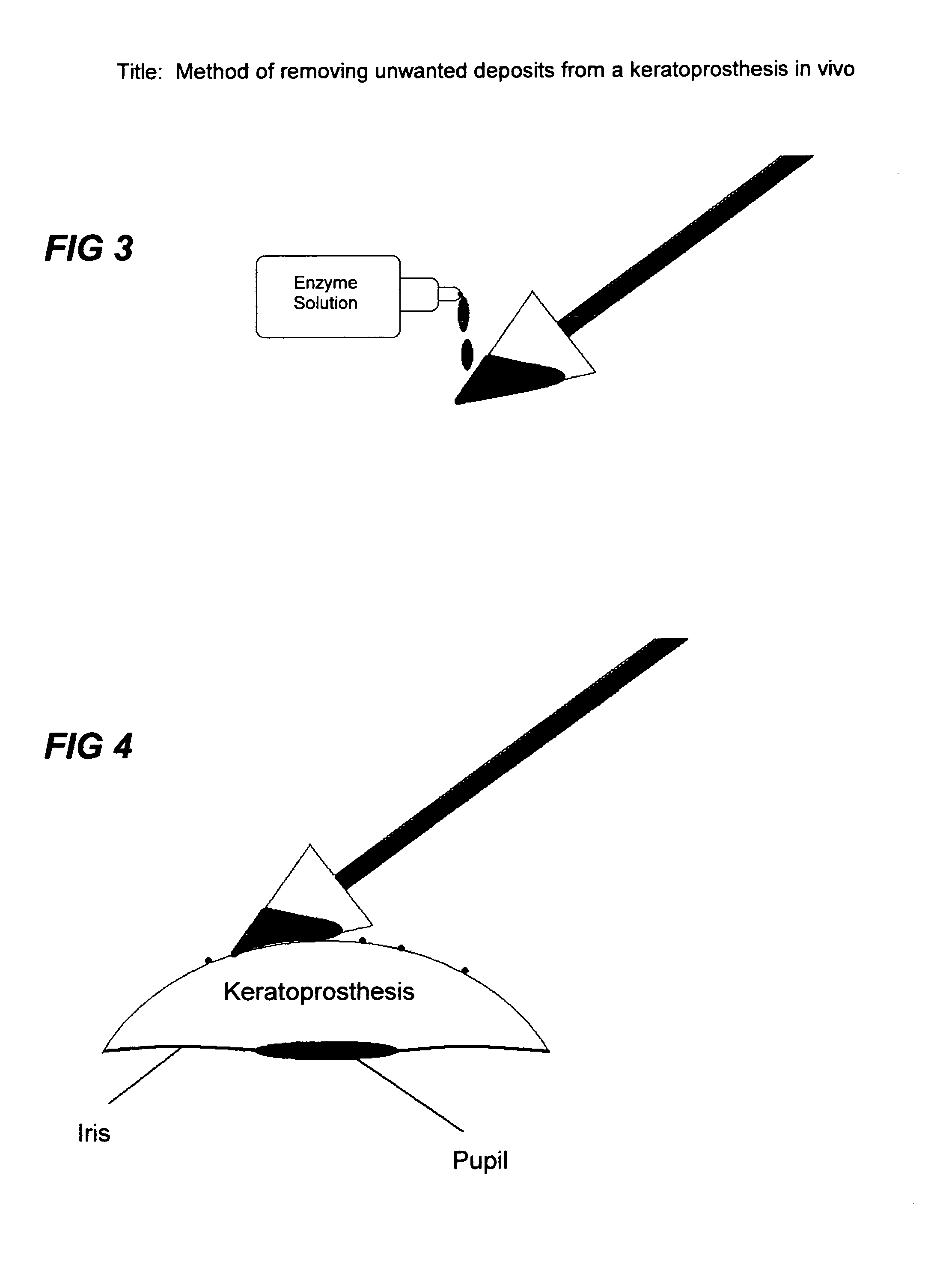 Method of removing unwanted deposits from a keratoprosthesis in vivo