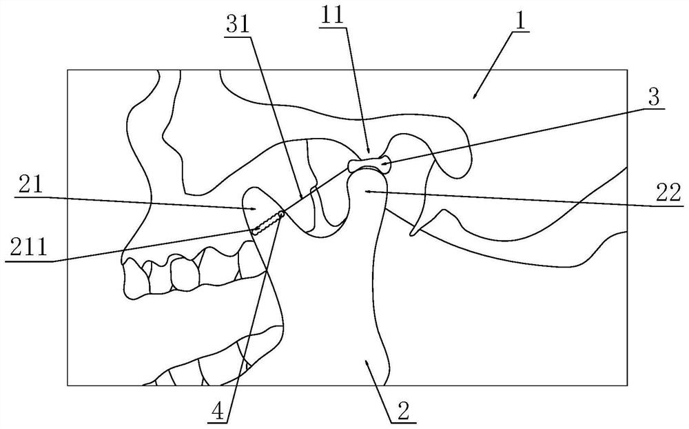 Temporomandibular joint disc anterior displacement model for teaching