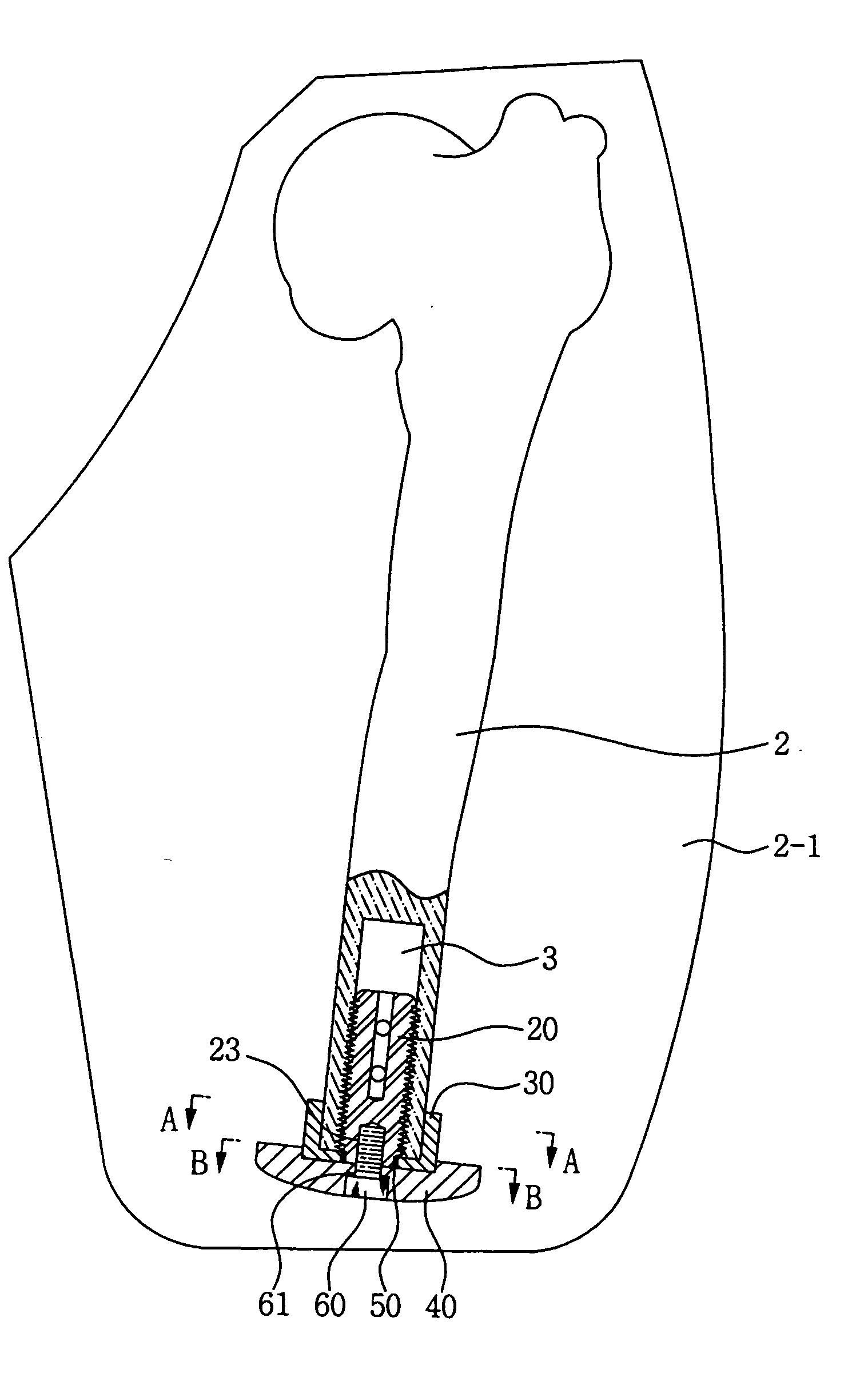 Implant device for osseointegration to endure weight