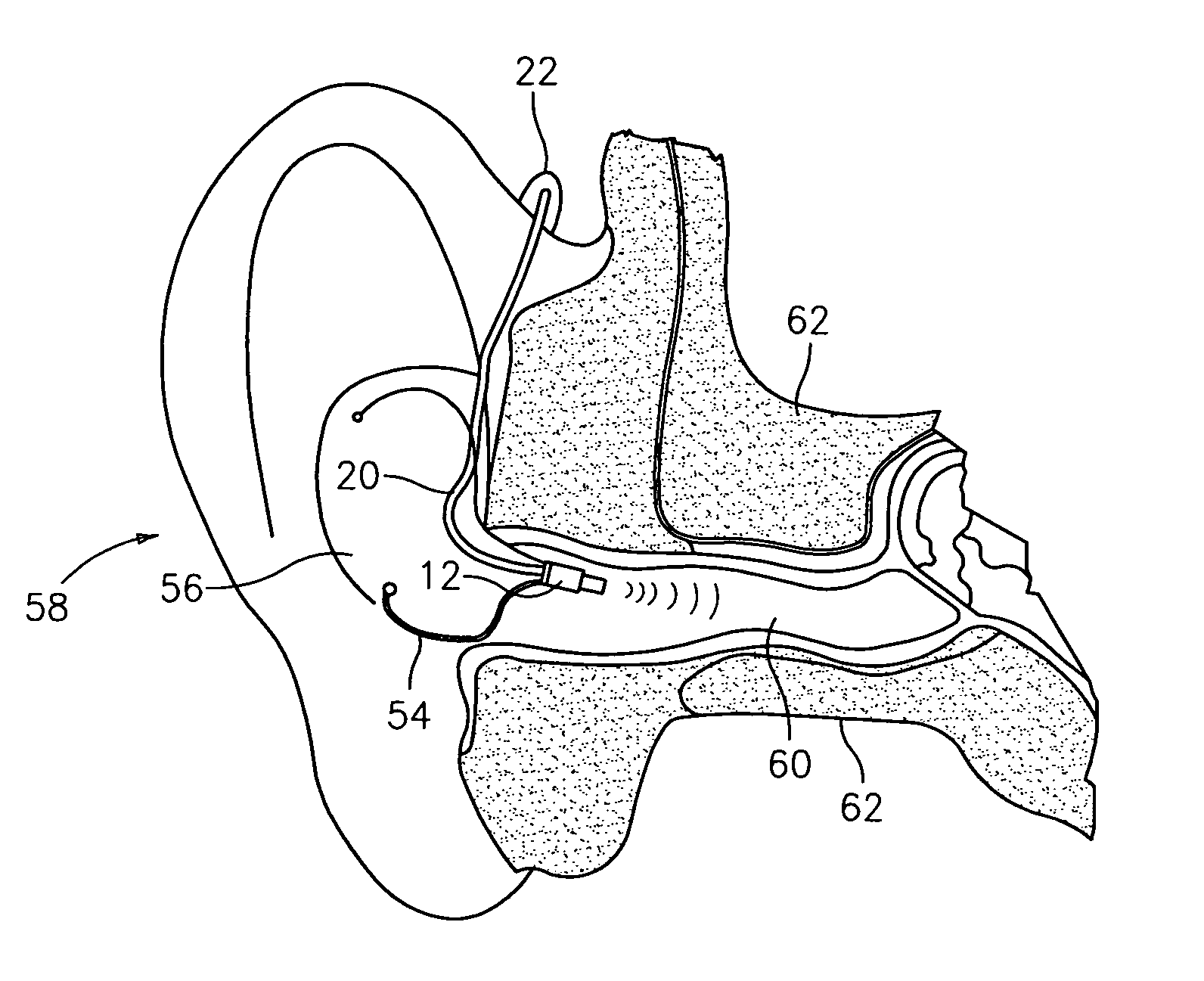Tinnitus treatment device