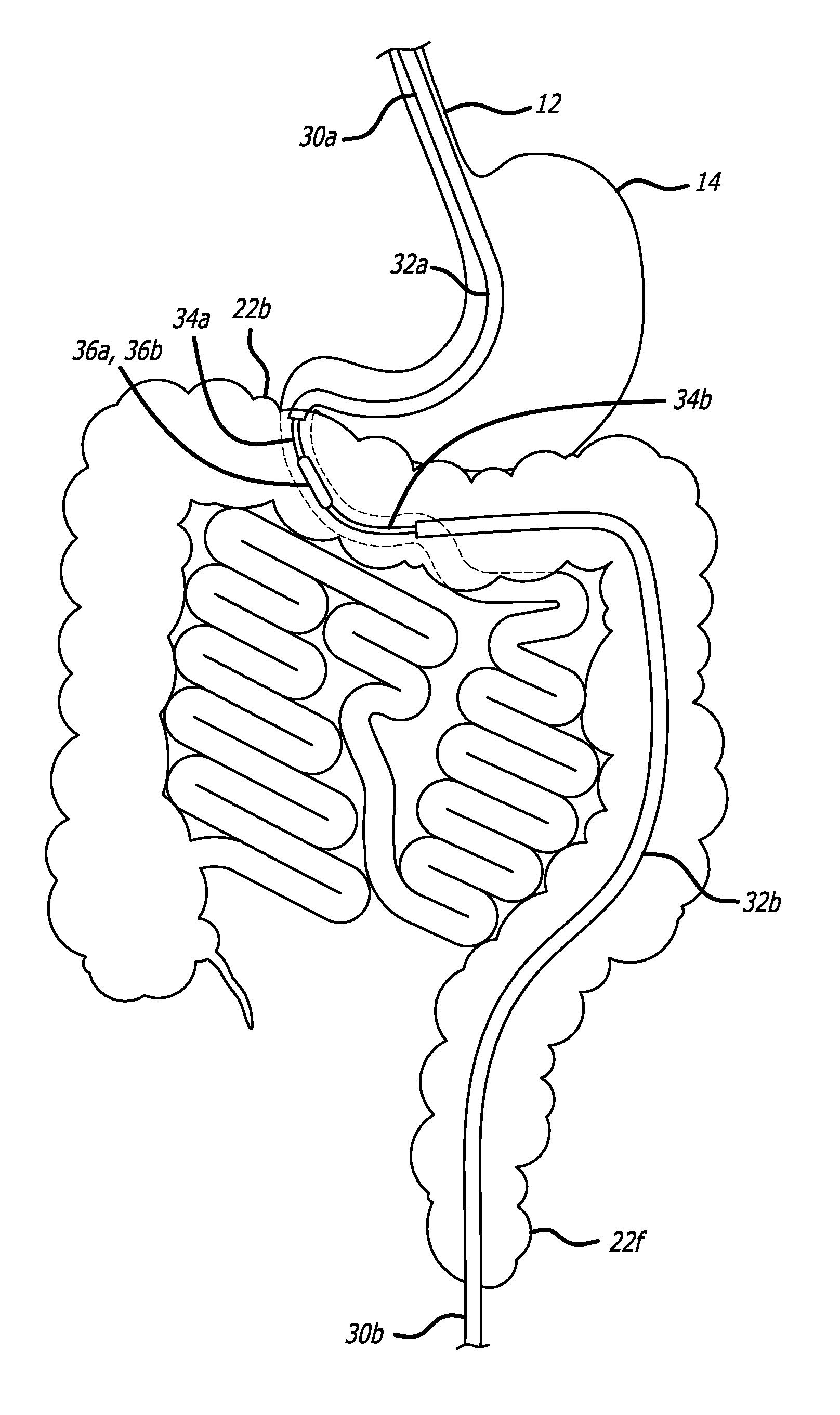 Incisionless Gastric Bypass Method And Devices