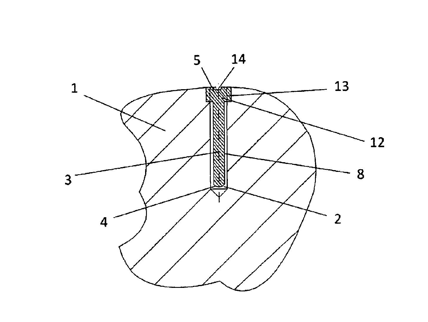 Electret implant for treatment of arthrosis