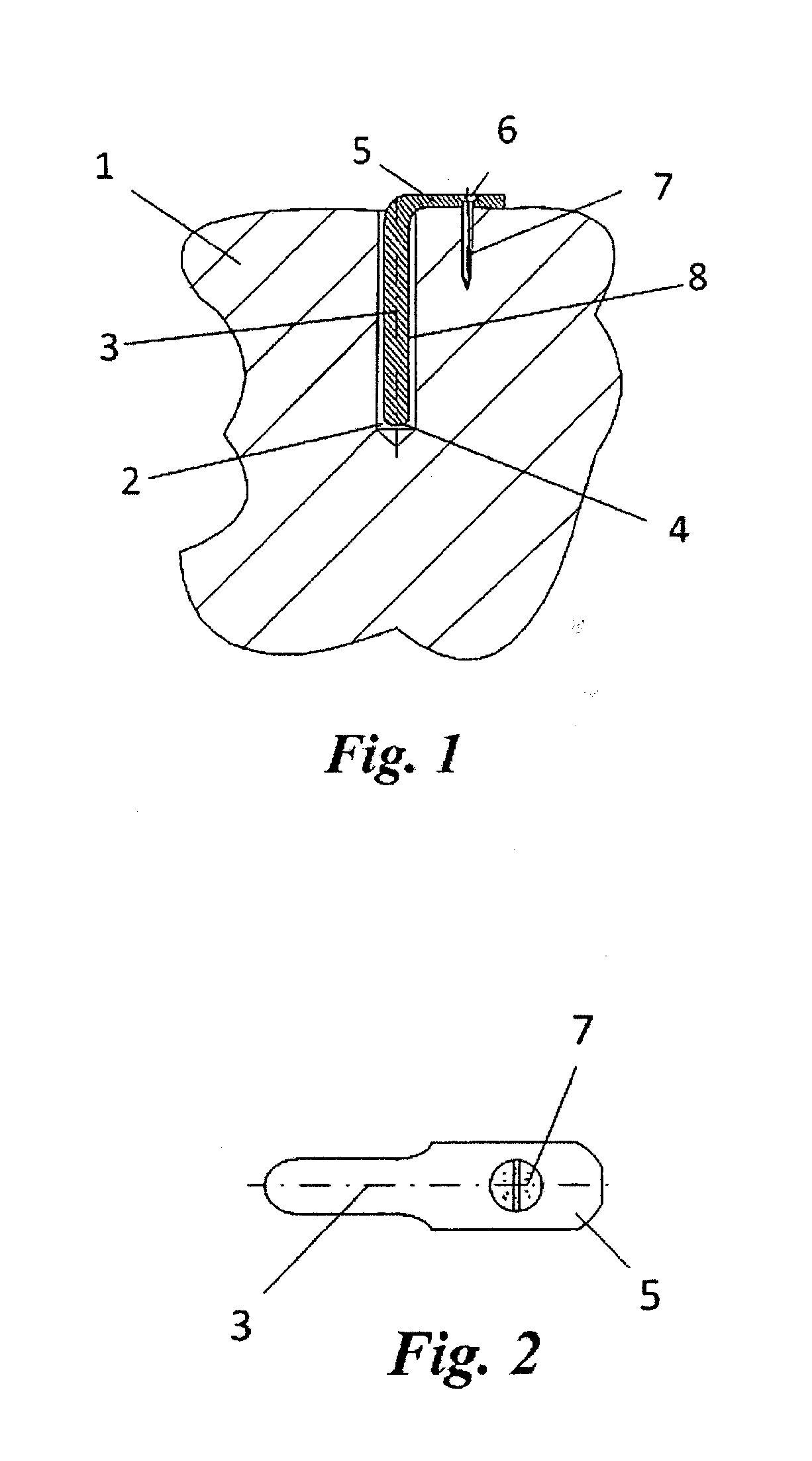 Electret implant for treatment of arthrosis