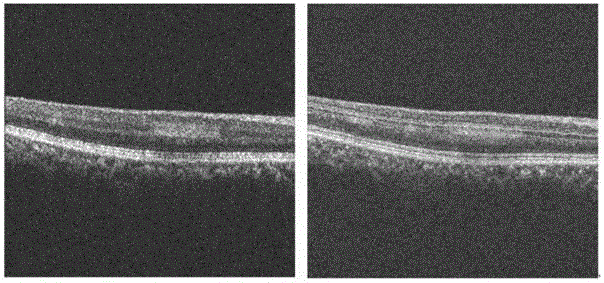 3d-oct-based grayscale analysis method between retinal layers
