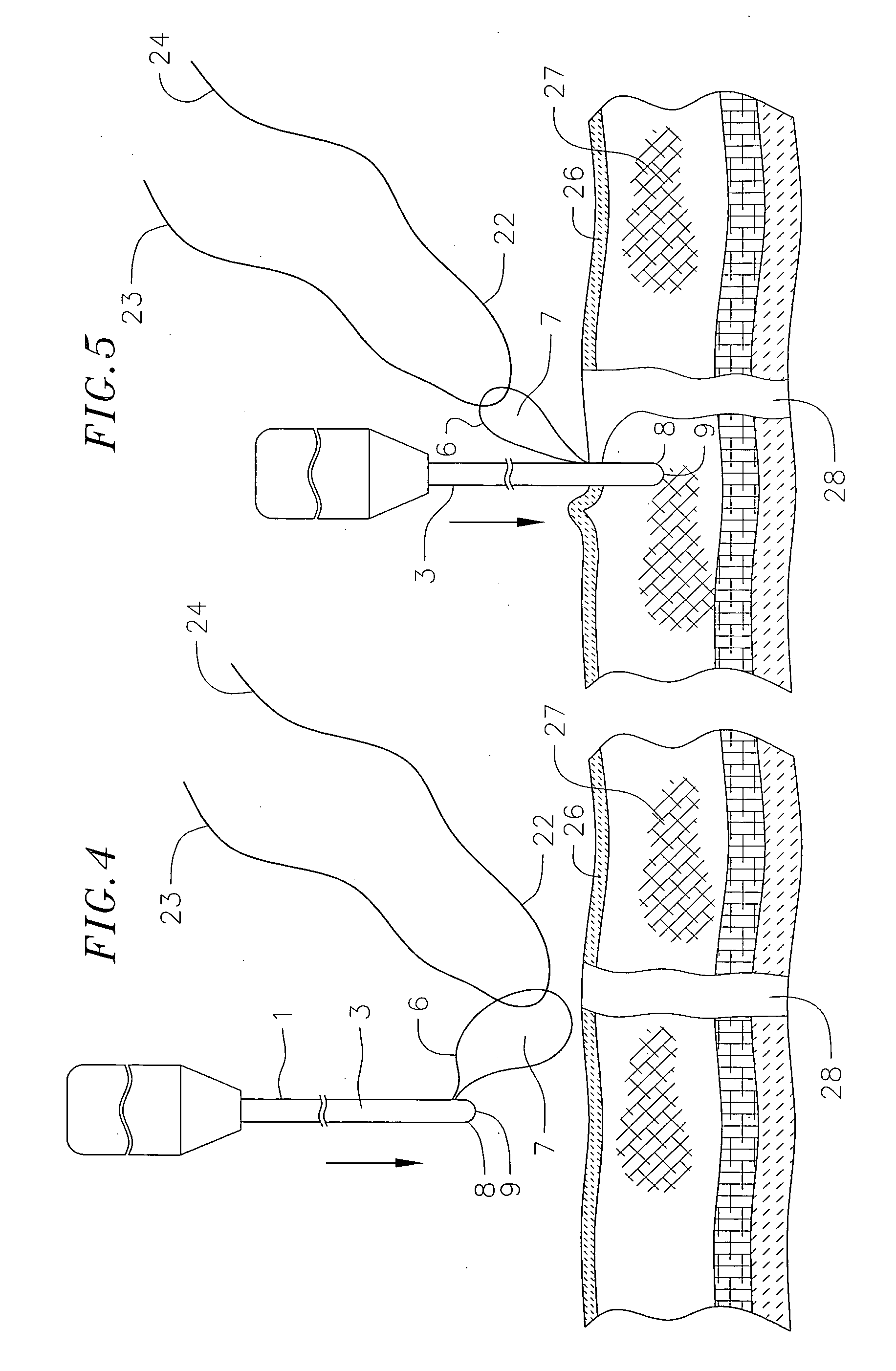 Suture passer device for abdominal or thoracoscopic surgery