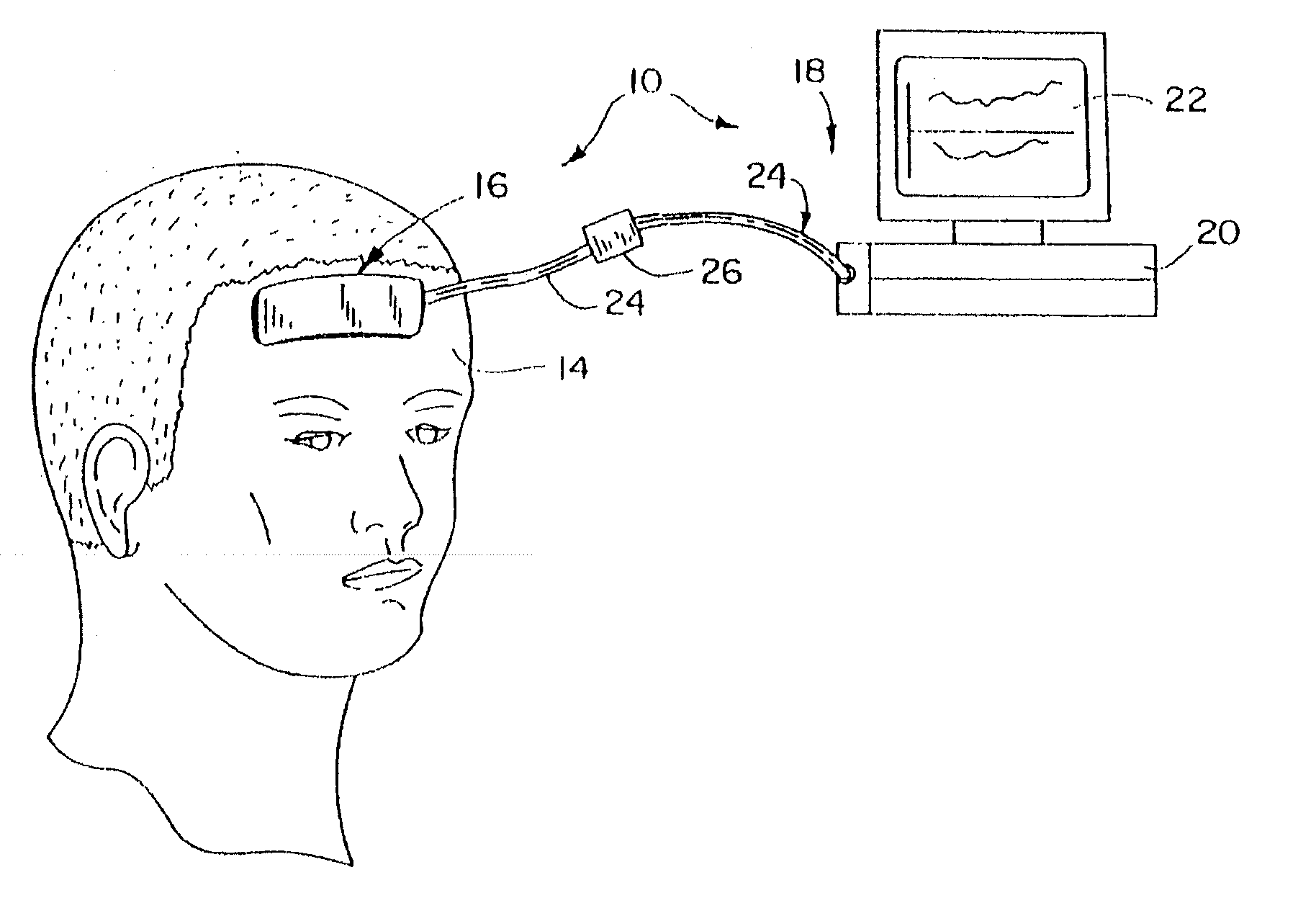 System and method of resolving outliers in nirs cerebral oximetry