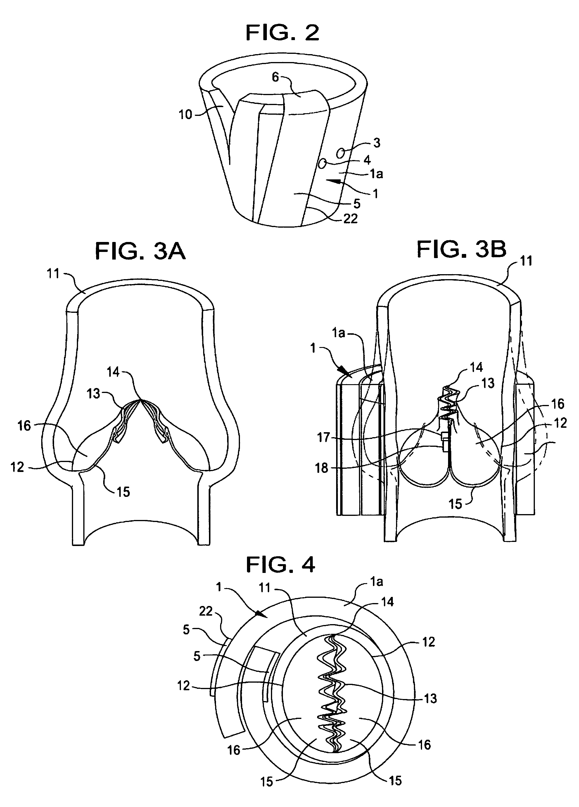 External venous valve stents for the correction of incompetent venous valves