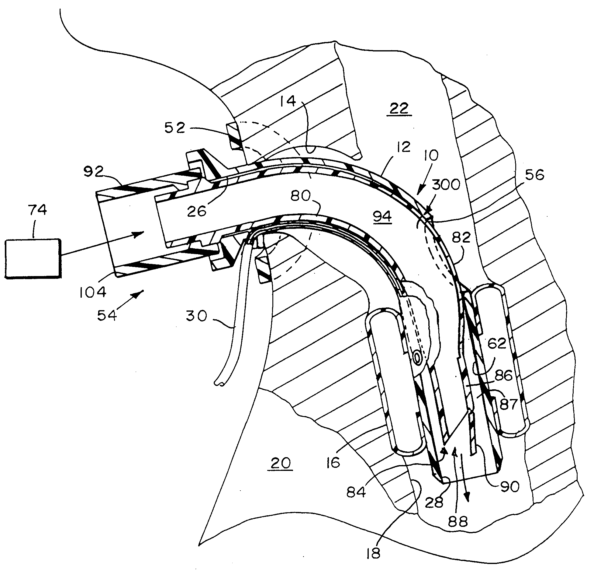 Valved Fenestrated Tracheotomy Tube Having Inner and Outer Cannulae with Pressure Relief